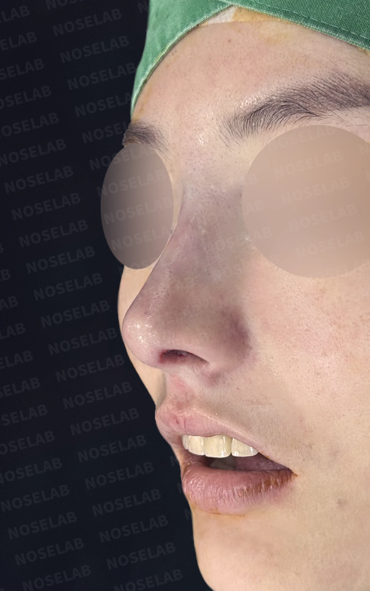 매부리코 교정, 자가늑연골로 자연스러운 코 라인 완성 — 전(좌) 직후(후)