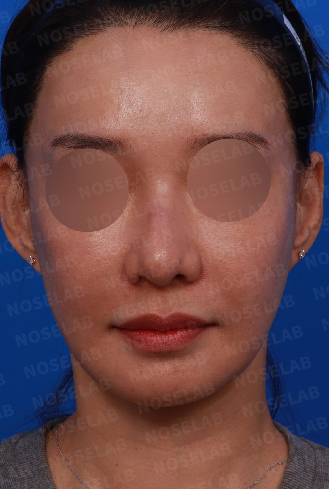 복코와 휜코의 구조를 살펴보는 교정 방법 — 디자인 상담 정면, 좌측 측면, 비스듬한 측면