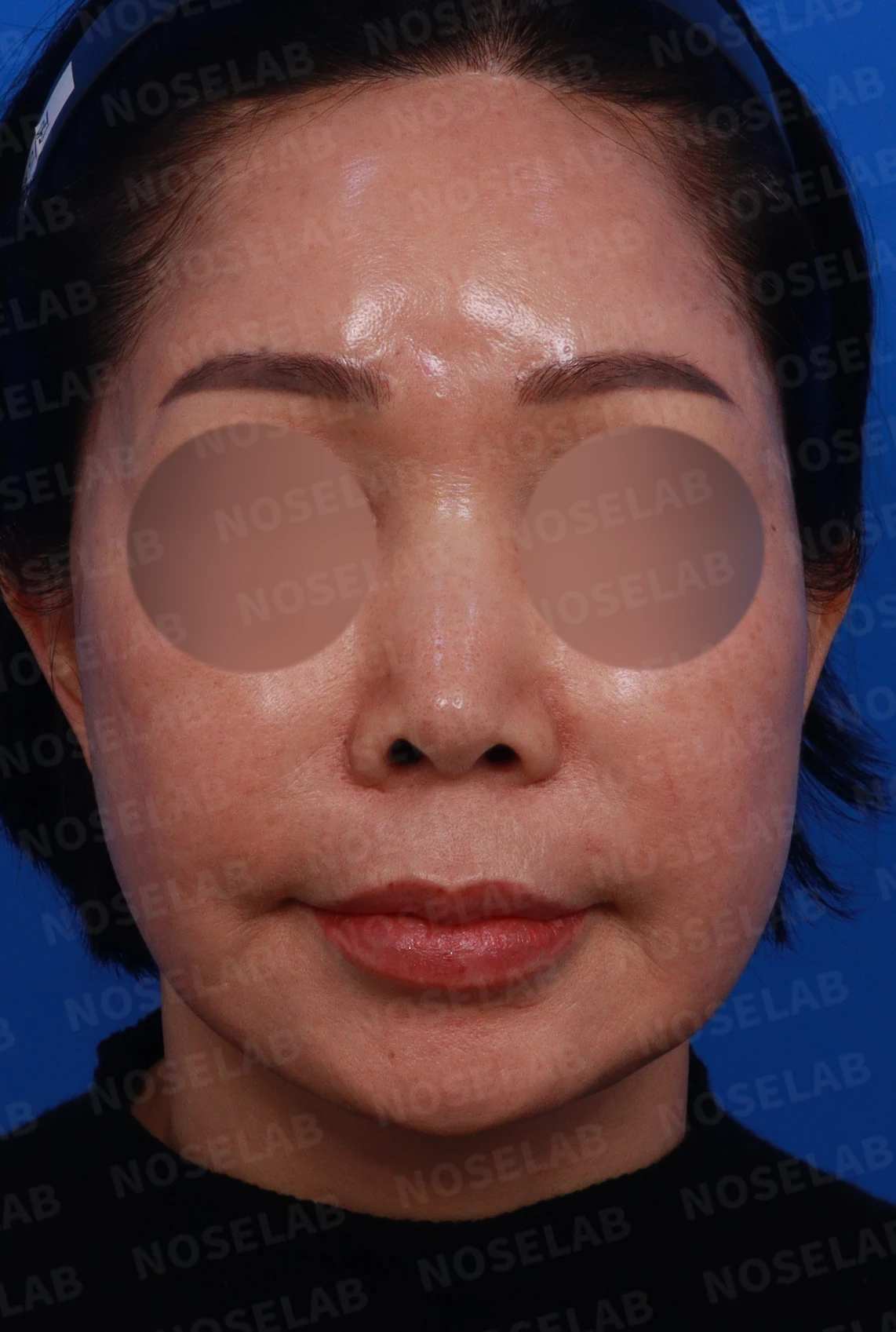코 안에 남은 메드포어와 이물질, 왜 문제가 되고 어떻게 제거하나 — 디자인 상담 정면, 좌측 측면, 비스듬한 측면 사진