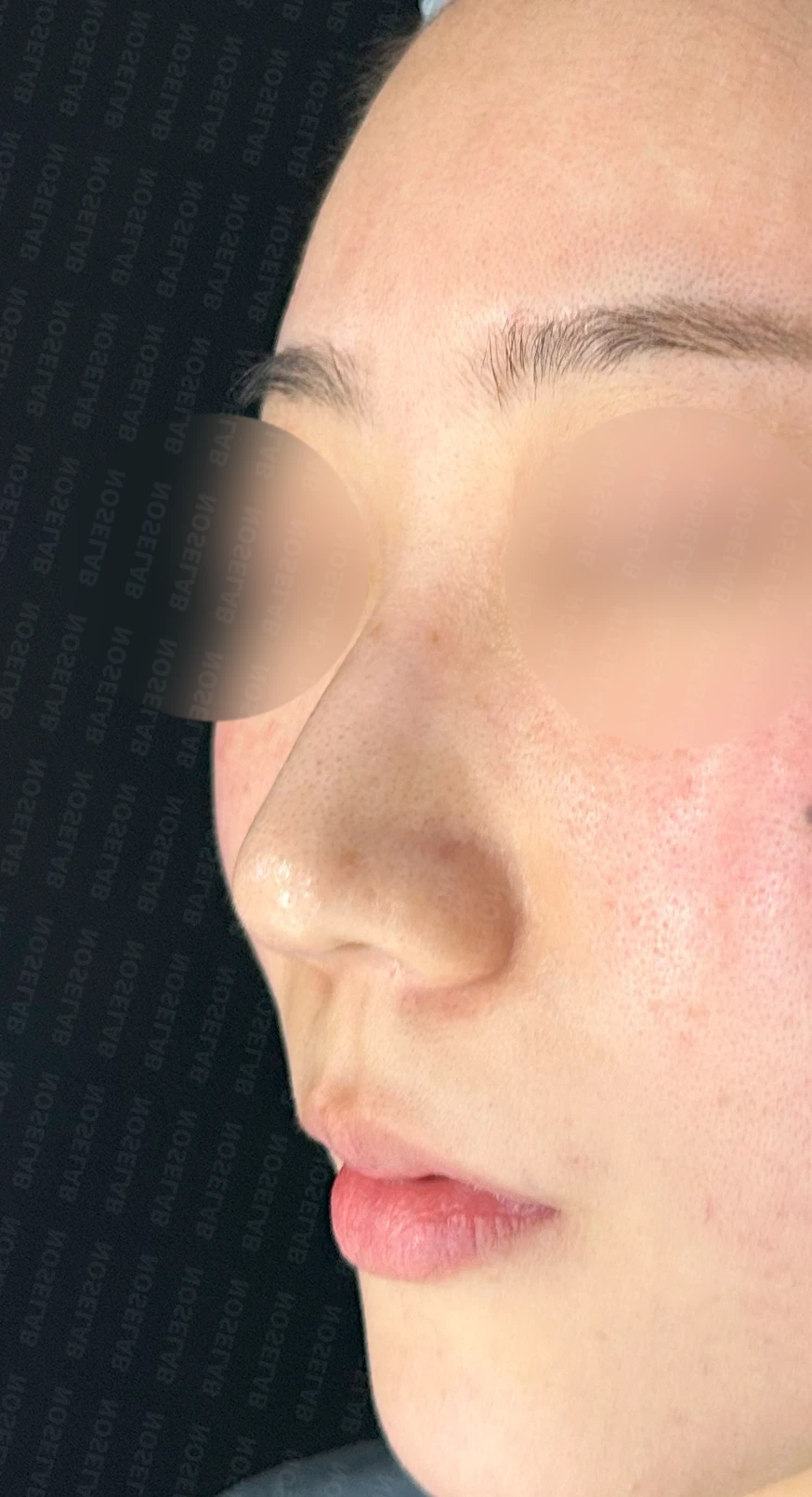 코뼈 비대칭과 처진 코끝에 만성 비염이 겹칠 때 보는 것 — 수술 전 / 수술 직후 0일 직후 사진은 부기가 있는 상태로 최종 결과와 다를 수 있습니다.
