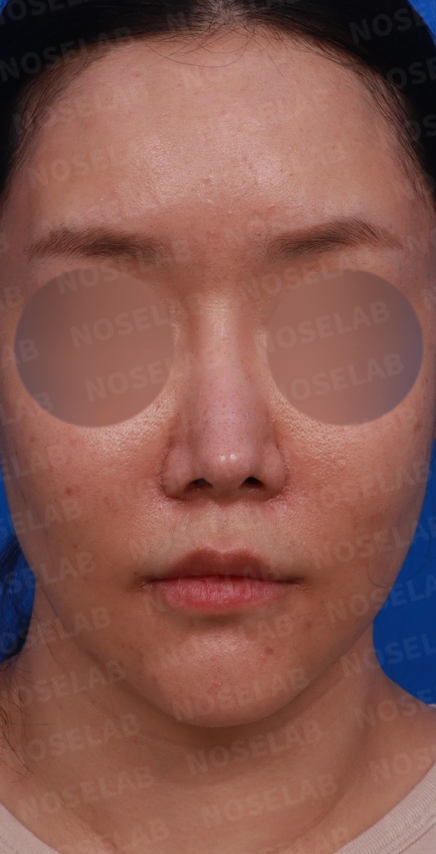 흡수된 기증늑연골을 자가늑연골로 교체 사례 — 디자인 상담 정면, 좌측 측면, 비스듬한 측면 사진