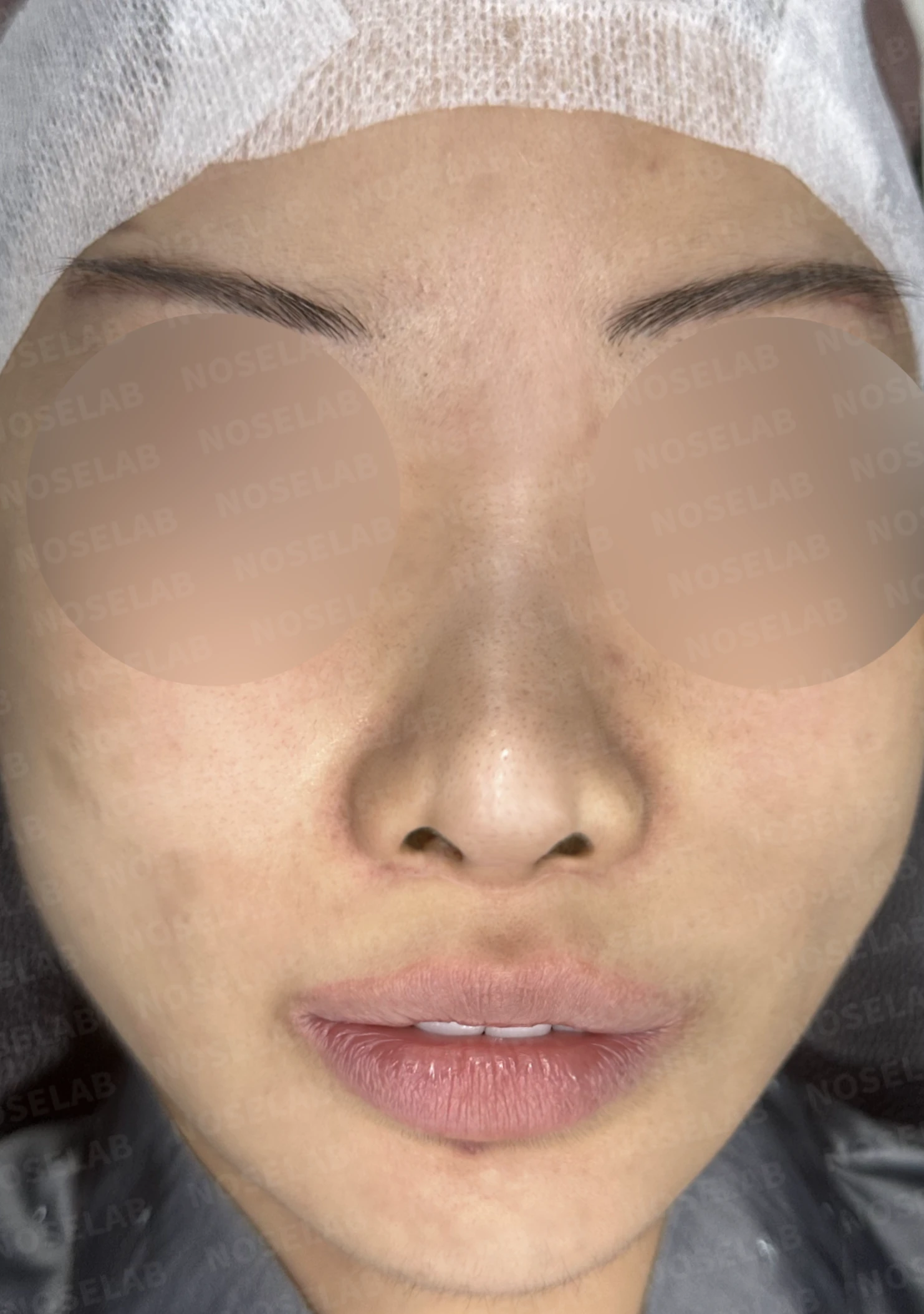 콧대 반영구 필러가 남기는 변화와 제거 후 비중격 재건 — 수술 전 / 수술 직후 0일 직후 사진은 부기가 있는 상태로 최종 결과와 다를 수 있습니다.