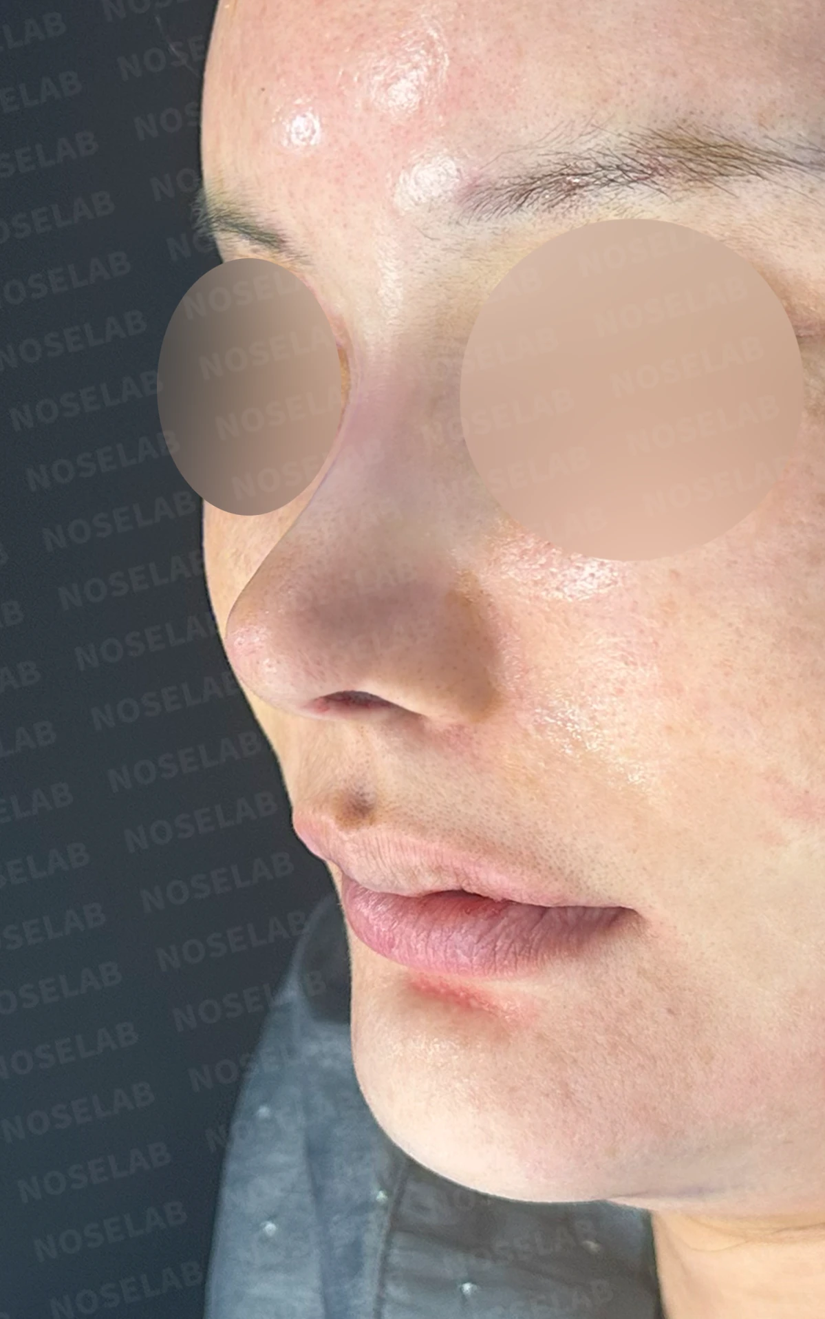 외상으로 코뼈가 부러지면 코가 어떻게 변형되고, 정복과 재건은 어떻게 하나 — 수술 전 / 수술 직후 0일 직후 사진은 부기가 있는 상태로 최종 결과와 다를 수 있습니다.