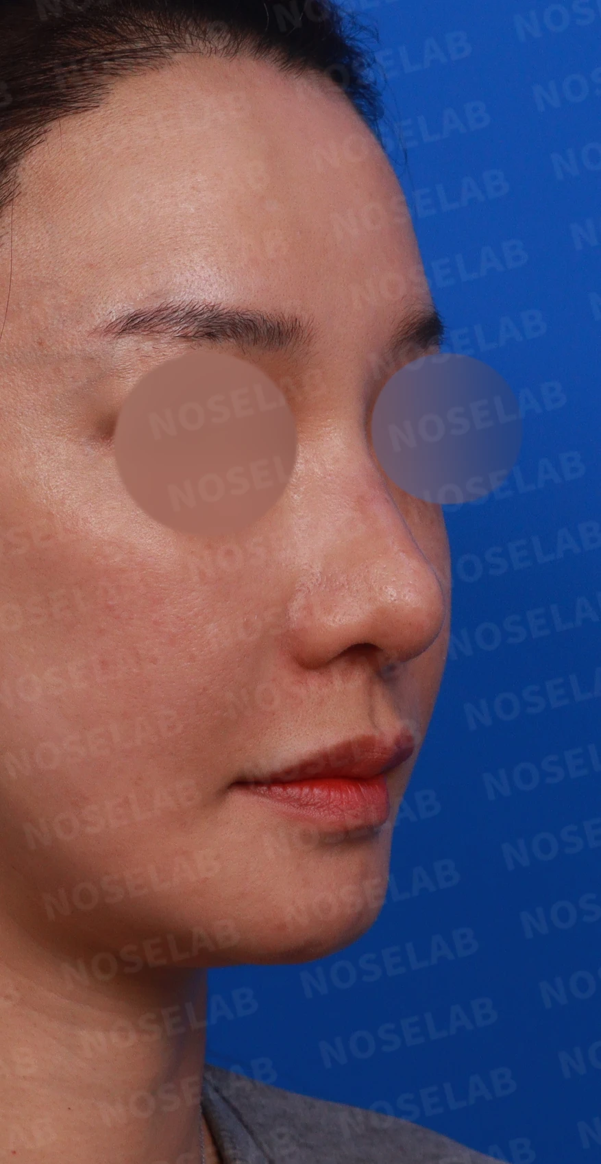 복코와 휜코의 구조를 살펴보는 교정 방법 — 디자인 상담 우측 비스듬한 측면, 측면, 비공 사진입니다.