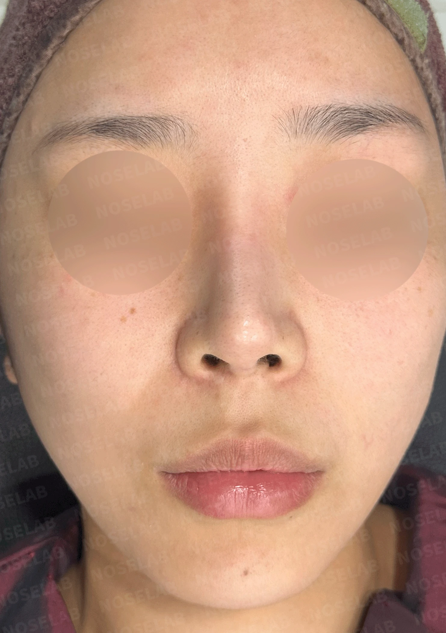 여러 번 수술한 코에 연골이 비치는 이유와 점막·구조 복원 방법 — 본문 사진 7