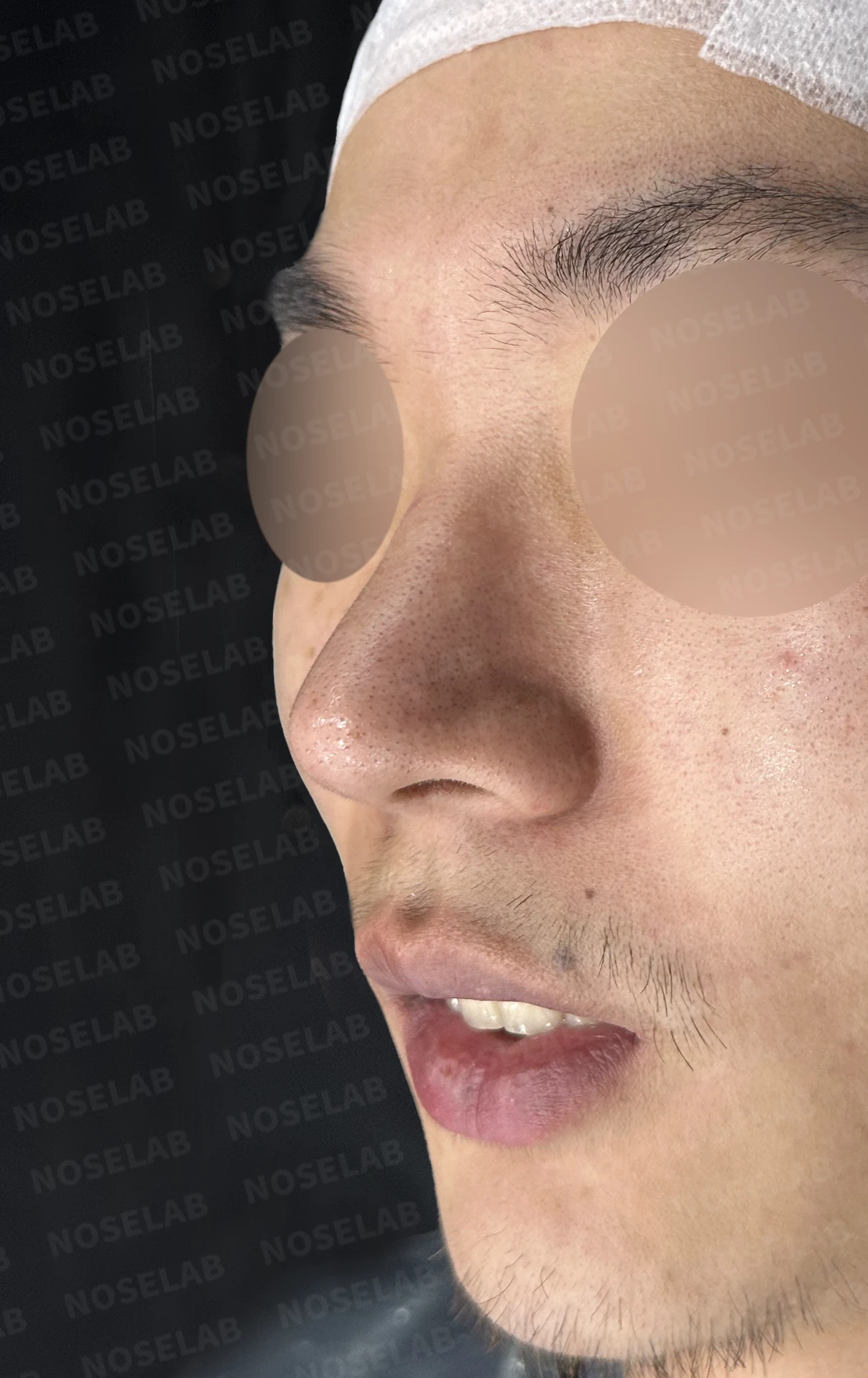 짧고 들린 코, 자가늑연골로 남성적인 라인으로 완성한 코재수술 — 전(좌) 직후(후)