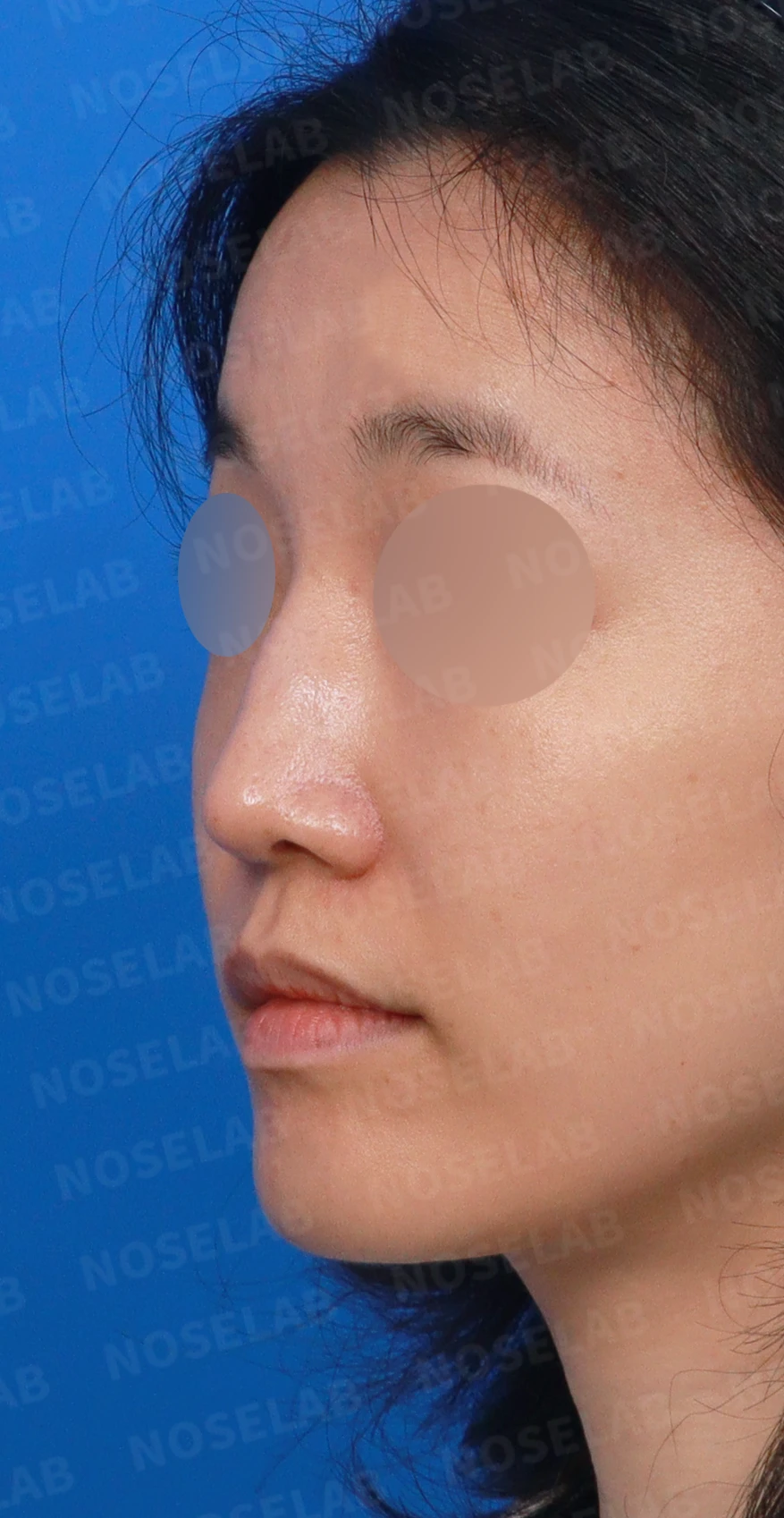 콧대 인공진피가 매부리로 남는 이유와 제거 후 재건 방법 — 디자인 상담 정면, 좌측 측면, 비스듬한 측면 사진입니다.