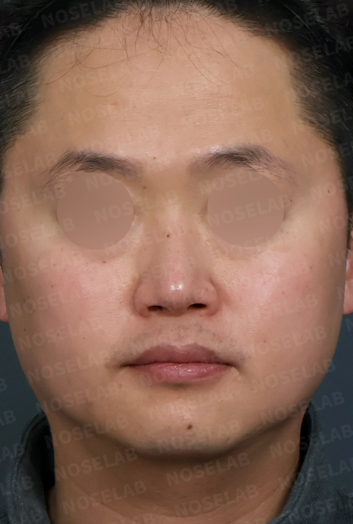 코막힘과 휘어진 비중격, 자가늑연골로 기능과 모양을 동시에 개선 — 디자인 상담 정면, 좌측 측면, 비스듬한 측면 사진입니다.