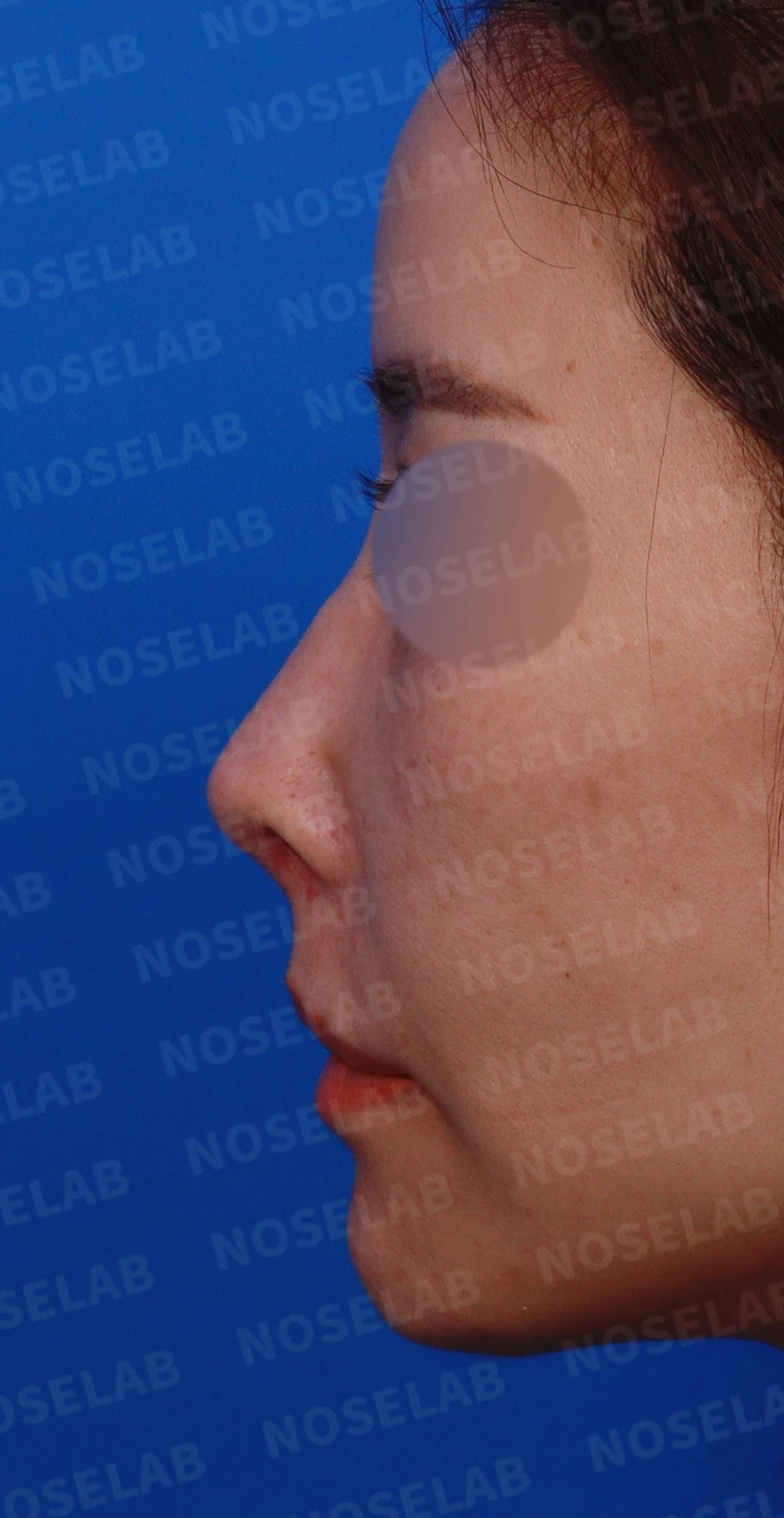 두꺼운 비주와 들린 코끝이 생기는 이유, 자가 늑연골 재건은 어떻게 하나 — 디자인 상담 정면, 좌측 측면, 비스듬한 측면 사진입니다.