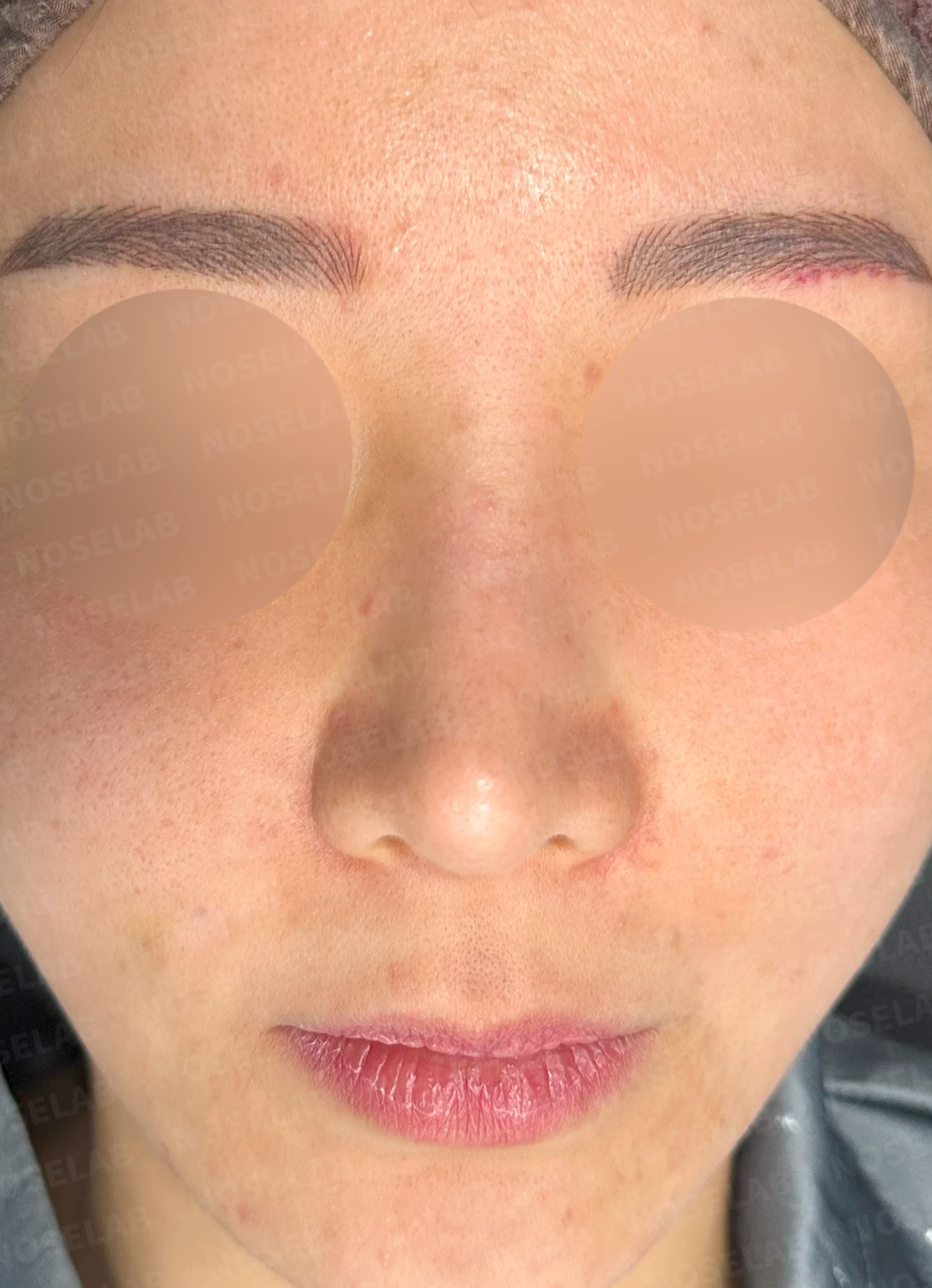 코가 휘어 보이고 비주가 한쪽으로 기우는 이유, 교정은 어떻게 하나 — 수술 전 / 수술 직후 0일 직후 사진은 부기가 있는 상태로 최종 결과와 다를 수 있습니다.
