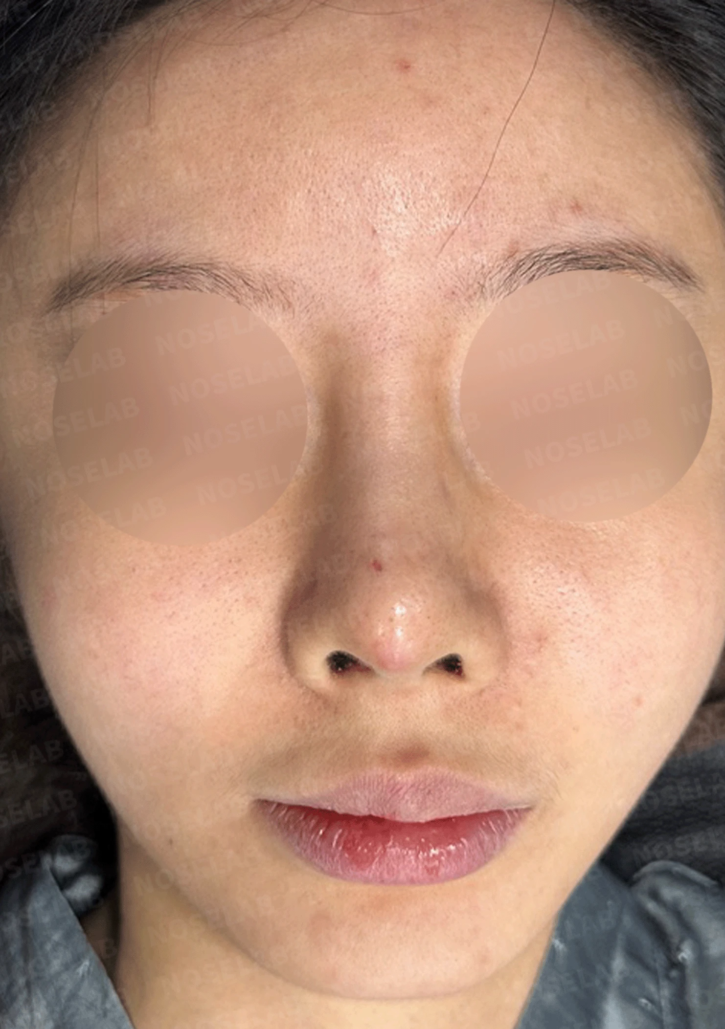 실리콘 보형물이 코끝 피부를 뚫고 나오려 할 때, 왜 생기고 어떻게 재건하나 — 본문 사진 13