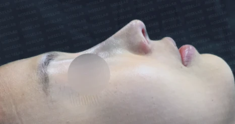 갈라져 보이는 코끝의 구조와 교정 방법 — 수술 전 / 수술 직후 0일 직후 사진은 부기가 있는 상태로 최종 결과와 다를 수 있습니다.