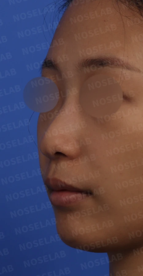 갈라져 보이는 코끝의 구조와 교정 방법 — 본문 사진 3