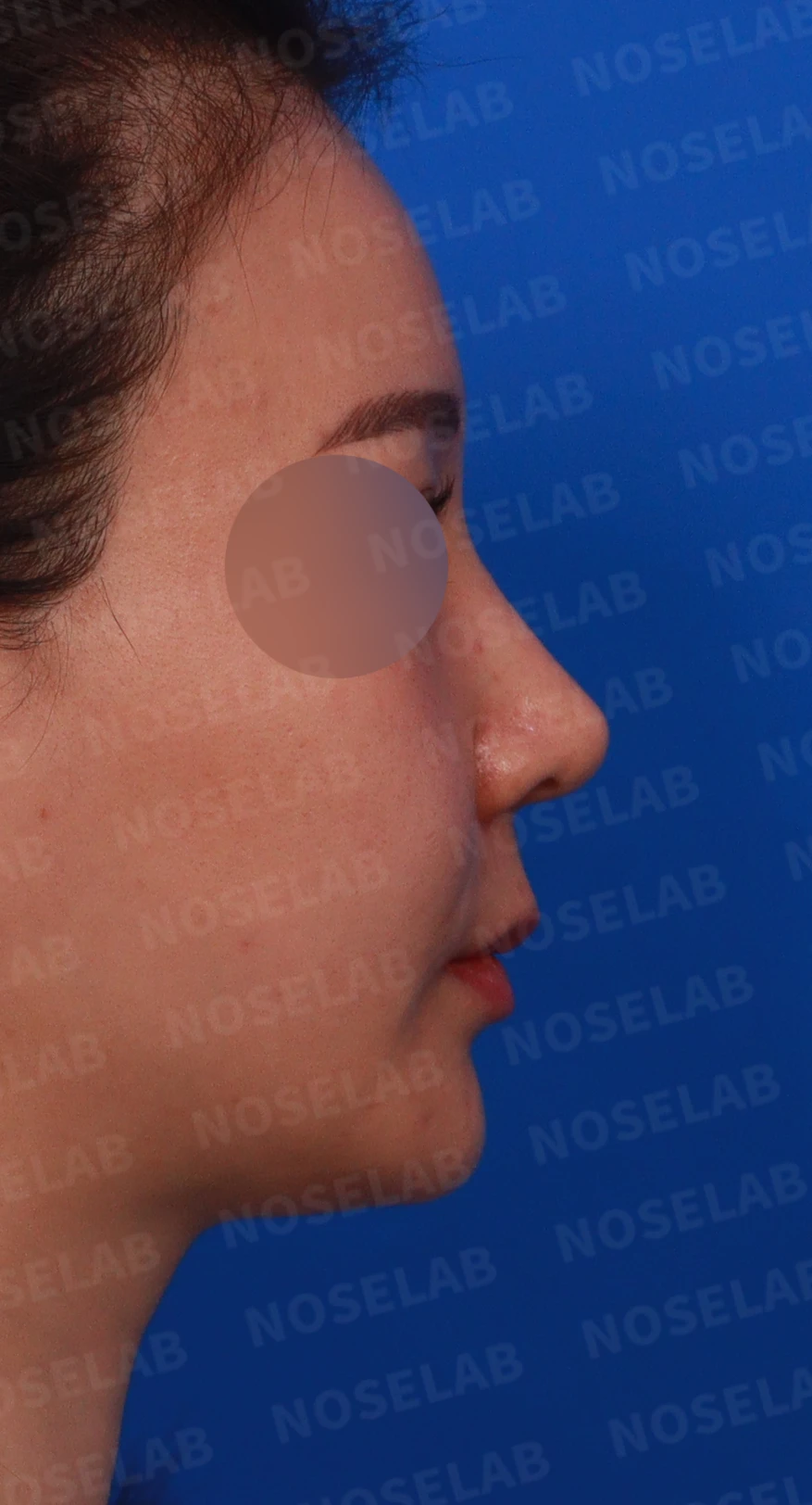 코가 휘어 보이고 비주가 한쪽으로 기우는 이유, 교정은 어떻게 하나 — 디자인 상담 우측 측면, 비스듬한 측면 비공 사진