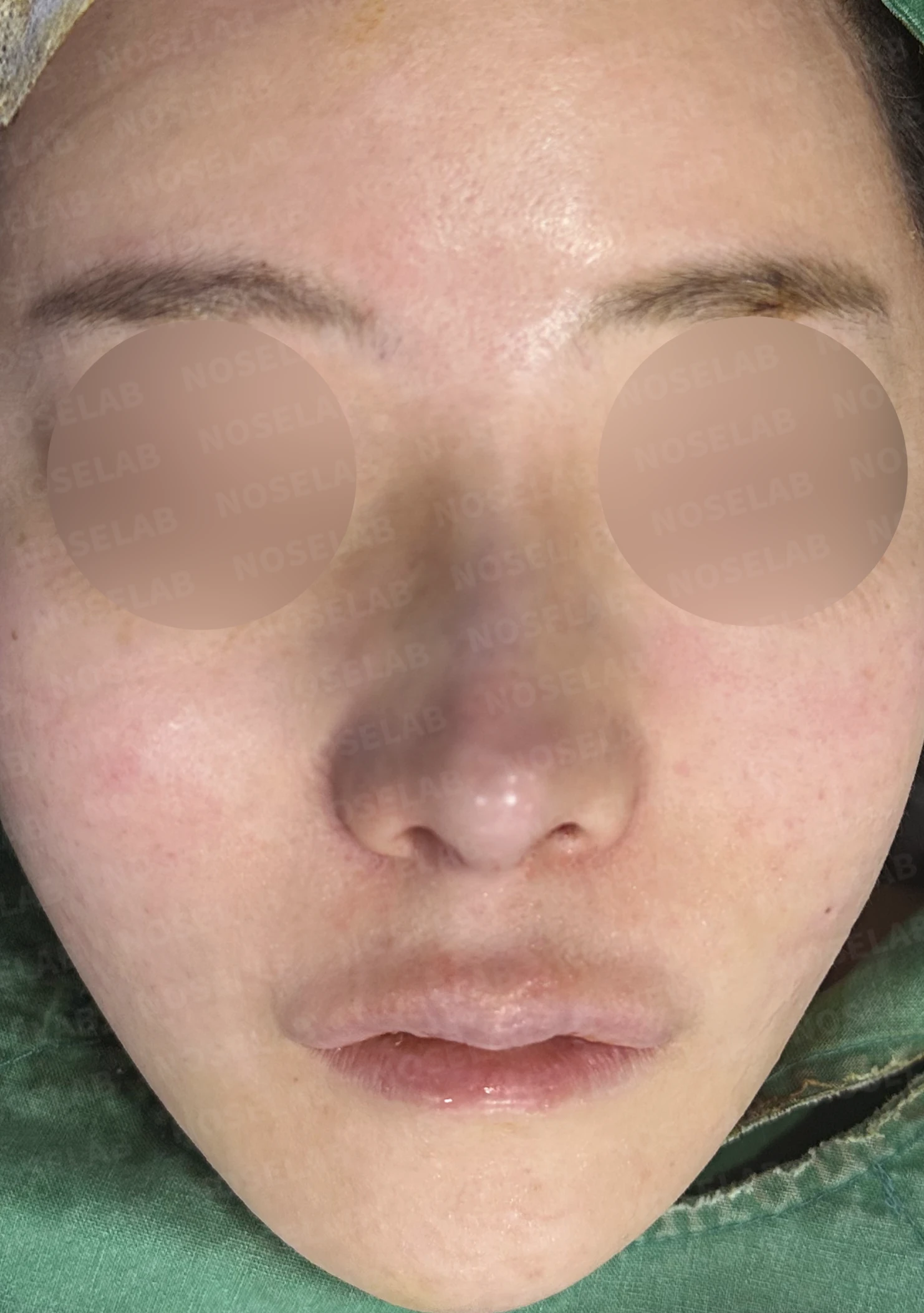 들린코 교정과 코막힘 개선, 자가늑연골로 코재수술 후기 — 전(좌) 직후(후)
