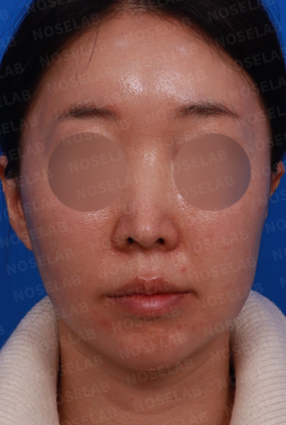 긴 코와 퍼진 콧대의 재수술 방법 — 디자인 상담 정면, 좌측 비스듬한 측면, 측면 사진