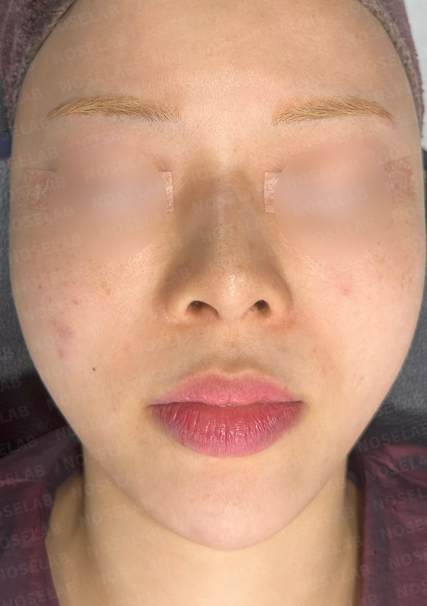 고개를 들면 콧구멍 모양이 다르고 코가 막히는 이유, 비중격 재건 방법 — 수술 전 / 수술 직후 0일 직후 사진은 부기가 있는 상태로 최종 결과와 다를 수 있습니다.