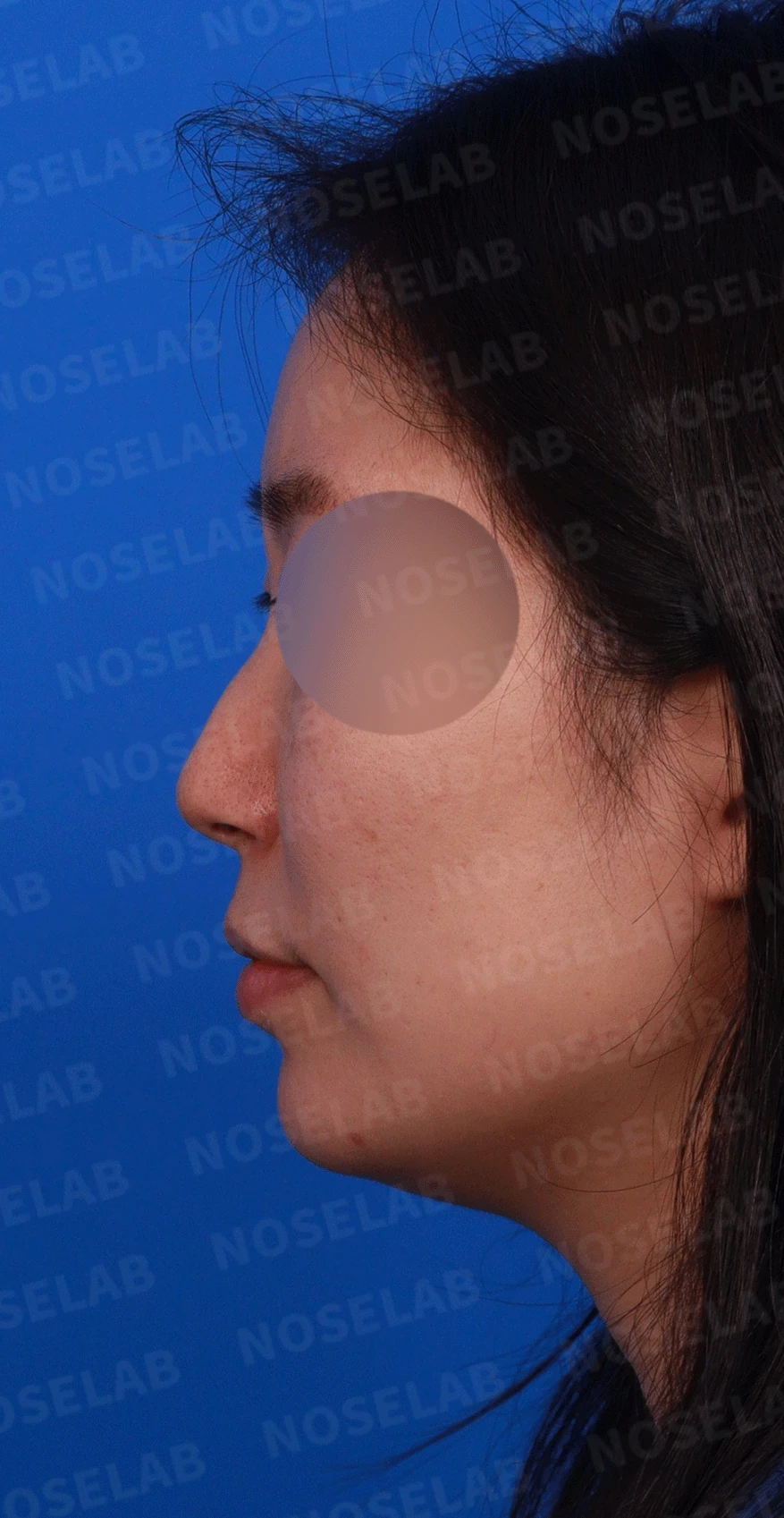 매부리코와 휜 코에 코막힘이 함께 오는 이유, 복합 교정은 어떻게 하나 — 디자인 상담 정면, 비스듬한 측면, 측면 사진입니다.