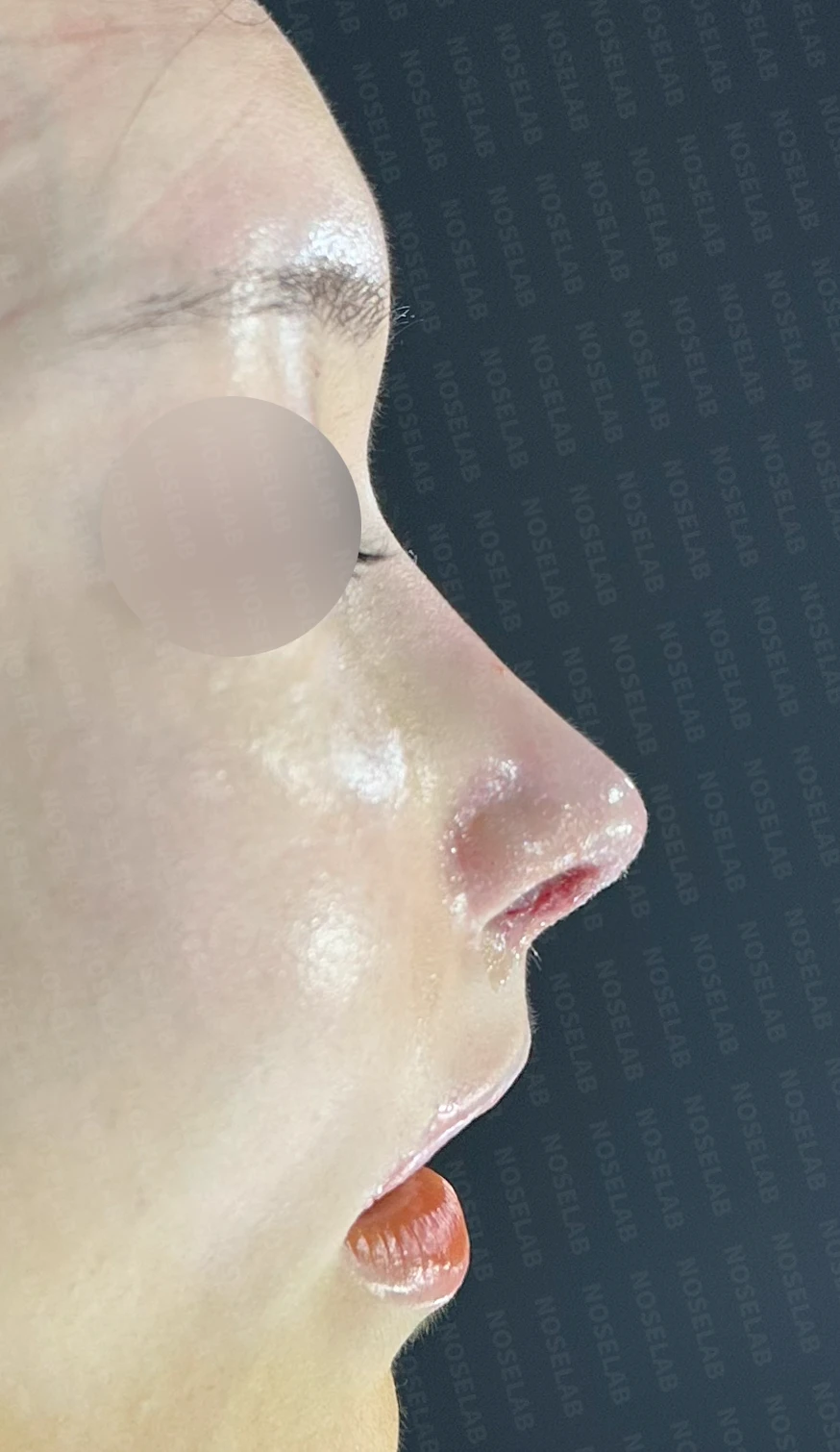 뾰족한 코끝과 연골 비침의 교정 방법 — 수술 직후 0일 정면, 측면, 비스듬한 측면 사진입니다. 직후 사진은 부기가 있는 상태로 최종 결과와 다를 수 있습니다.