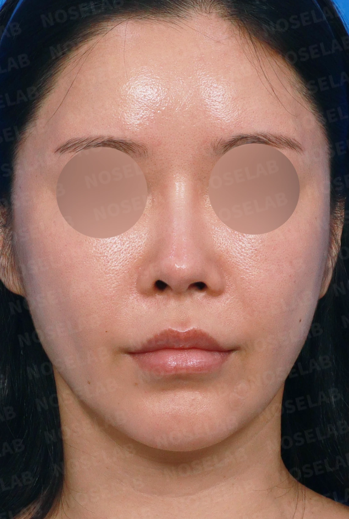 비중격 완전 재건으로 오똑한 코끝과 비공 비대칭 교정 — 디자인 상담 정면, 좌측 측면, 비스듬한 측면 사진입니다.