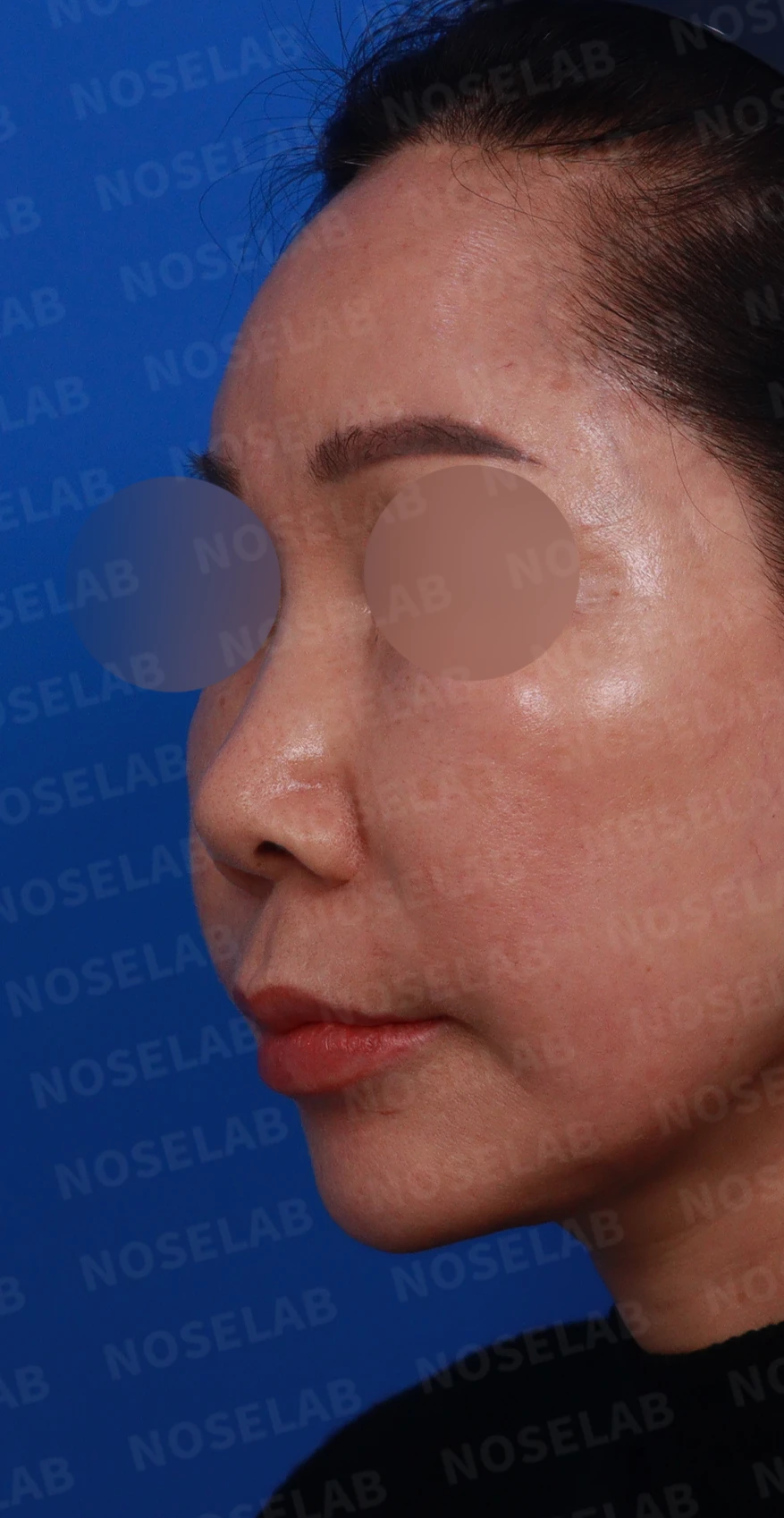 코 안에 남은 메드포어와 이물질, 왜 문제가 되고 어떻게 제거하나 — 디자인 상담 정면, 좌측 측면, 비스듬한 측면 사진