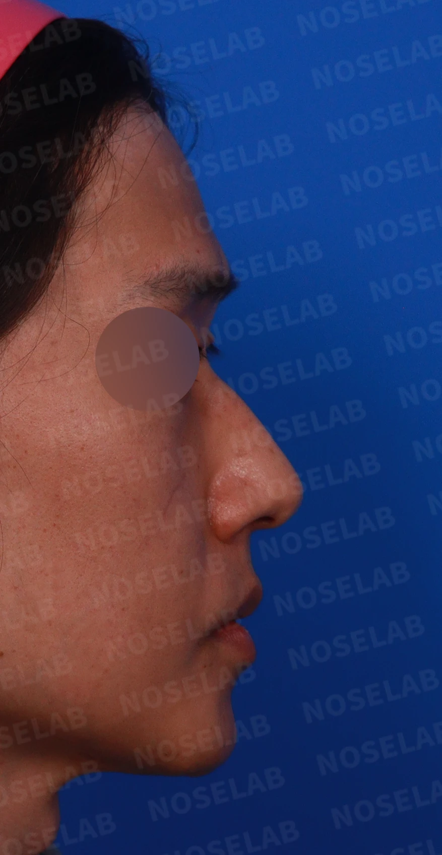 안면 비대칭이 있는 코에 맞춤형 보형물을 쓰는 이유와 매부리 교정 방법 — 디자인 상담 우측 측면,비스듬한 측면, 비공 사진입니다.