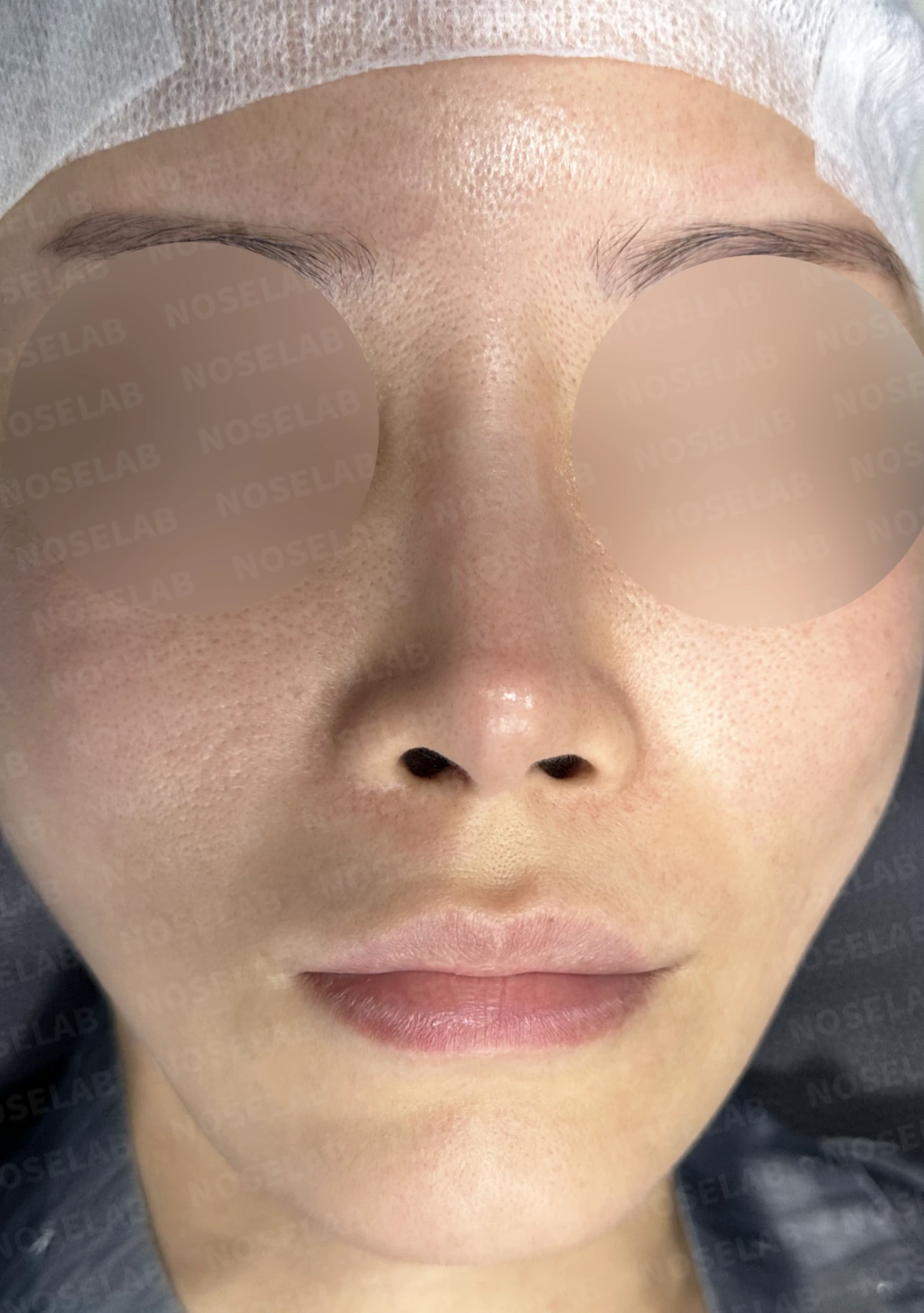 비중격 완전 재건으로 오똑한 코끝과 비공 비대칭 교정 — 전(좌) , 직후(후)