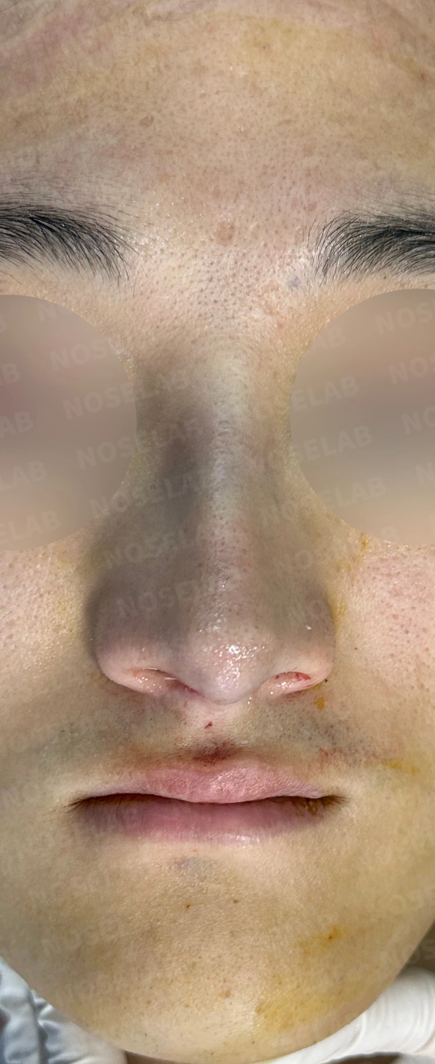 휜코 교정하면 안면 비대칭이 좋아질까요? — 수술 직후 0일 사진들입니다. 직후 사진은 부기가 있는 상태로 최종 결과와 다를 수 있습니다.