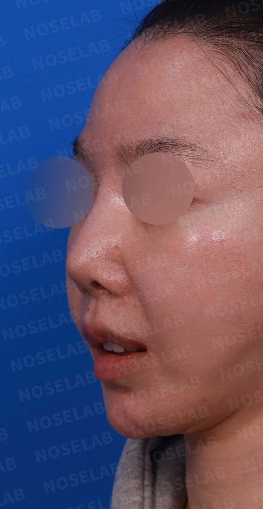 콧대가 뭉툭하게 퍼져 보이는 만성 이물 반응, 원인과 재건 방법 — 디자인 상담 정면, 좌측 측면, 비스듬한 측면 사진