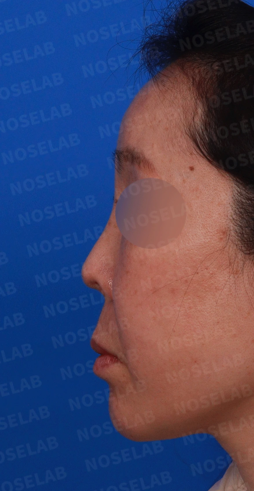 코가 짧고 들리며 비주가 함몰되는 이유, 자가 늑연골 재건은 어떻게 하나 — 디자인 상담 정면, 좌측 측면, 비스듬한 측면 사진