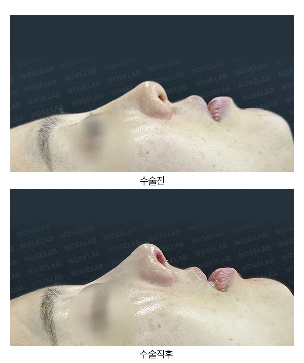 작고 뭉툭한 코의 교정 방법 — 본문 사진 15