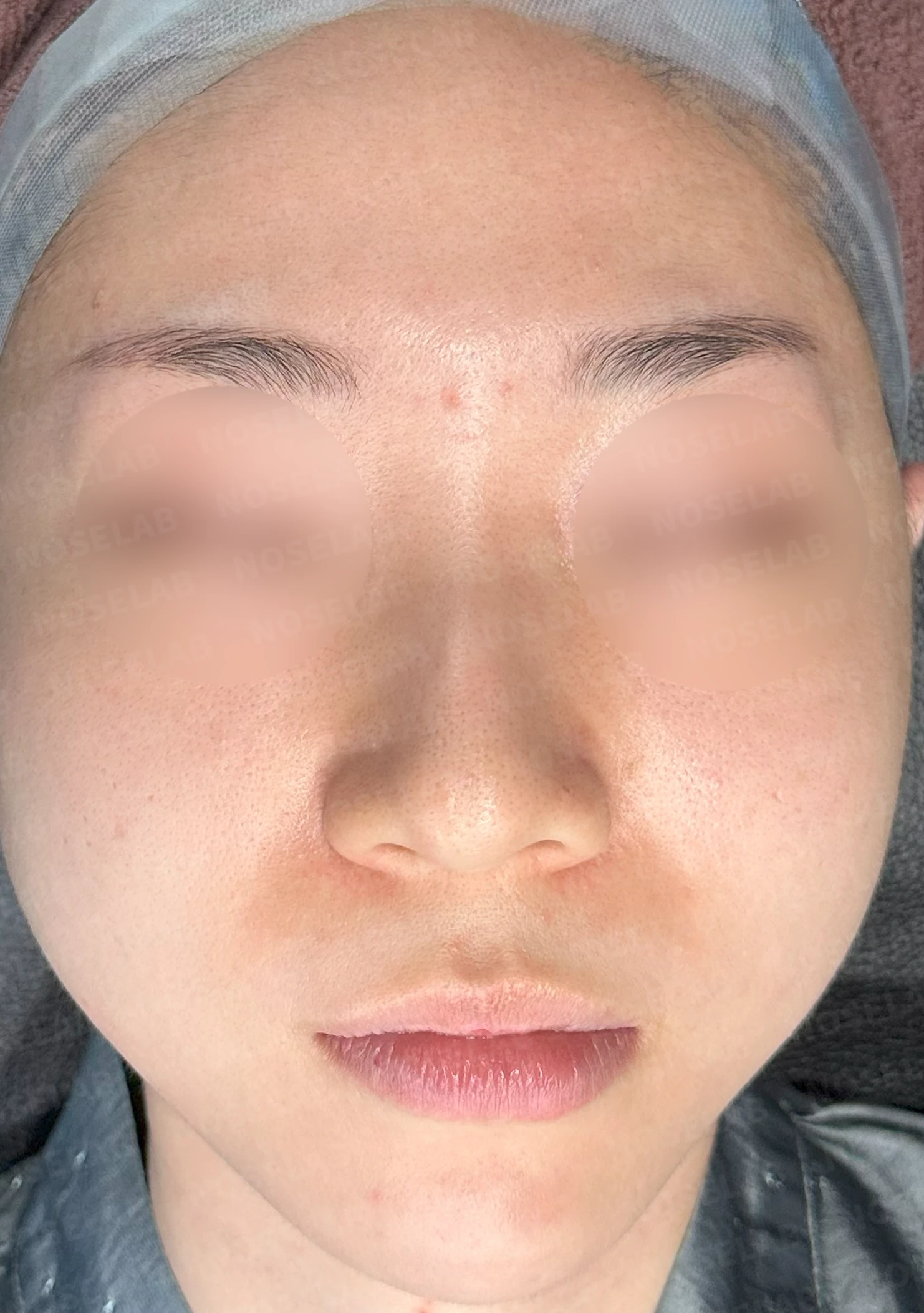 퍼진 코와 복코를 함께 교정하는 방법 — 수술 전 / 수술 직후 0일 직후 사진은 부기가 있는 상태로 최종 결과와 다를 수 있습니다.