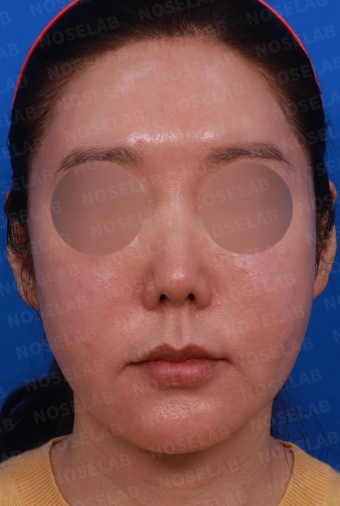 매부리를 깎은 뒤 다시 매부리가 보이고 콧구멍이 드러나는 이유 — 디자인 상담 정면, 좌측 측면, 측면 사진