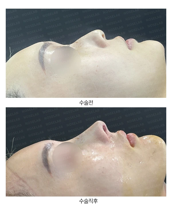 처진 코끝의 지지 구조와 교정 방법 — 전후 비교