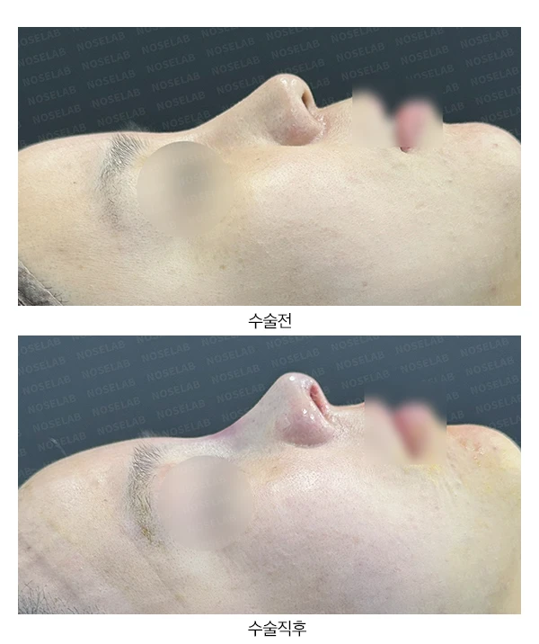 이물질제거후 코성형 방법 — 본문 사진 18