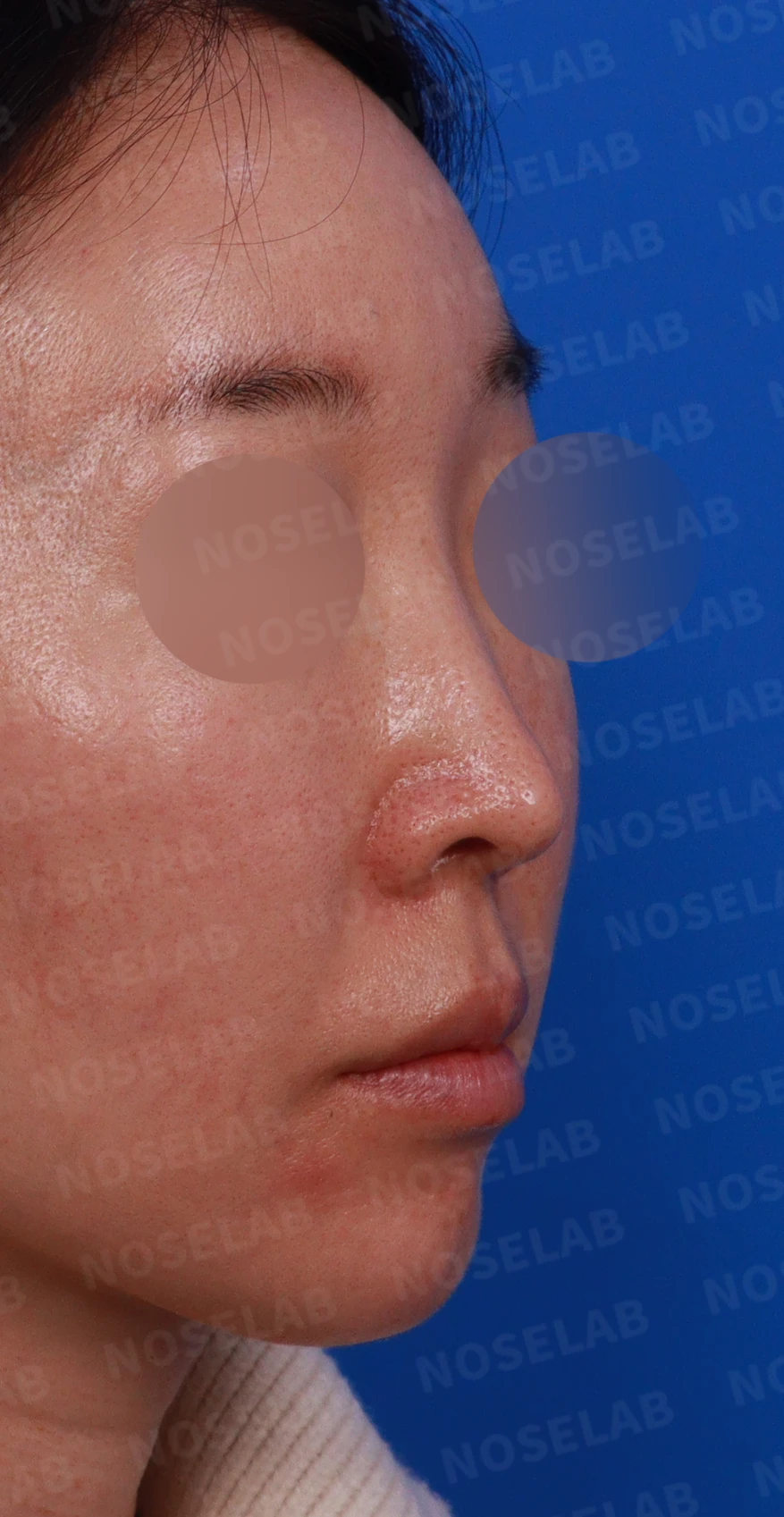 긴 코와 퍼진 콧대의 재수술 방법 — 디자인 상담 우측 비스듬한 측면, 측면, 비공 사진