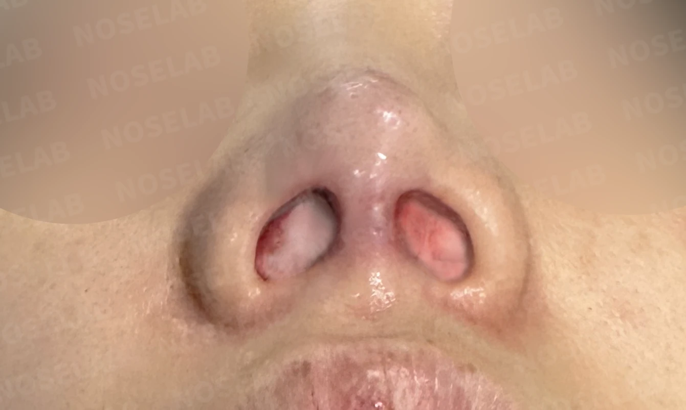 코끝 피부가 얇아져 연골이 비치는 이유, 피부 보강은 어떻게 하나 — 수술 전 / 수술 직후 0일 직후 사진은 부기가 있는 상태로 최종 결과와 다를 수 있습니다.