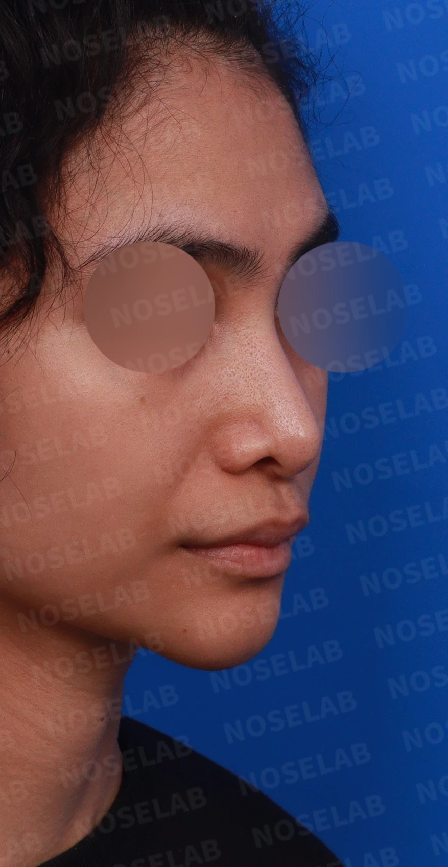 비주가 심하게 처지고 화살코가 되는 이유와 늑연골 재건 방법 — 디자인 상담 우측 측면, 비스듬한 측면, 비공 사진입니다.