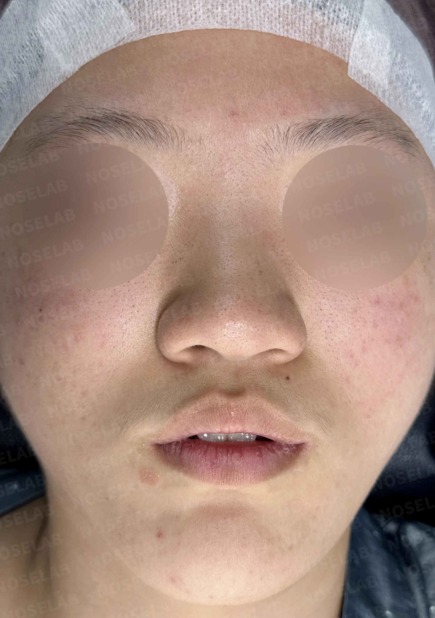 뭉툭한 코끝과 퍼진 코, 자가늑연골 비중격 연장술로 자연스럽게 교정 — 전(좌) 직후(후)