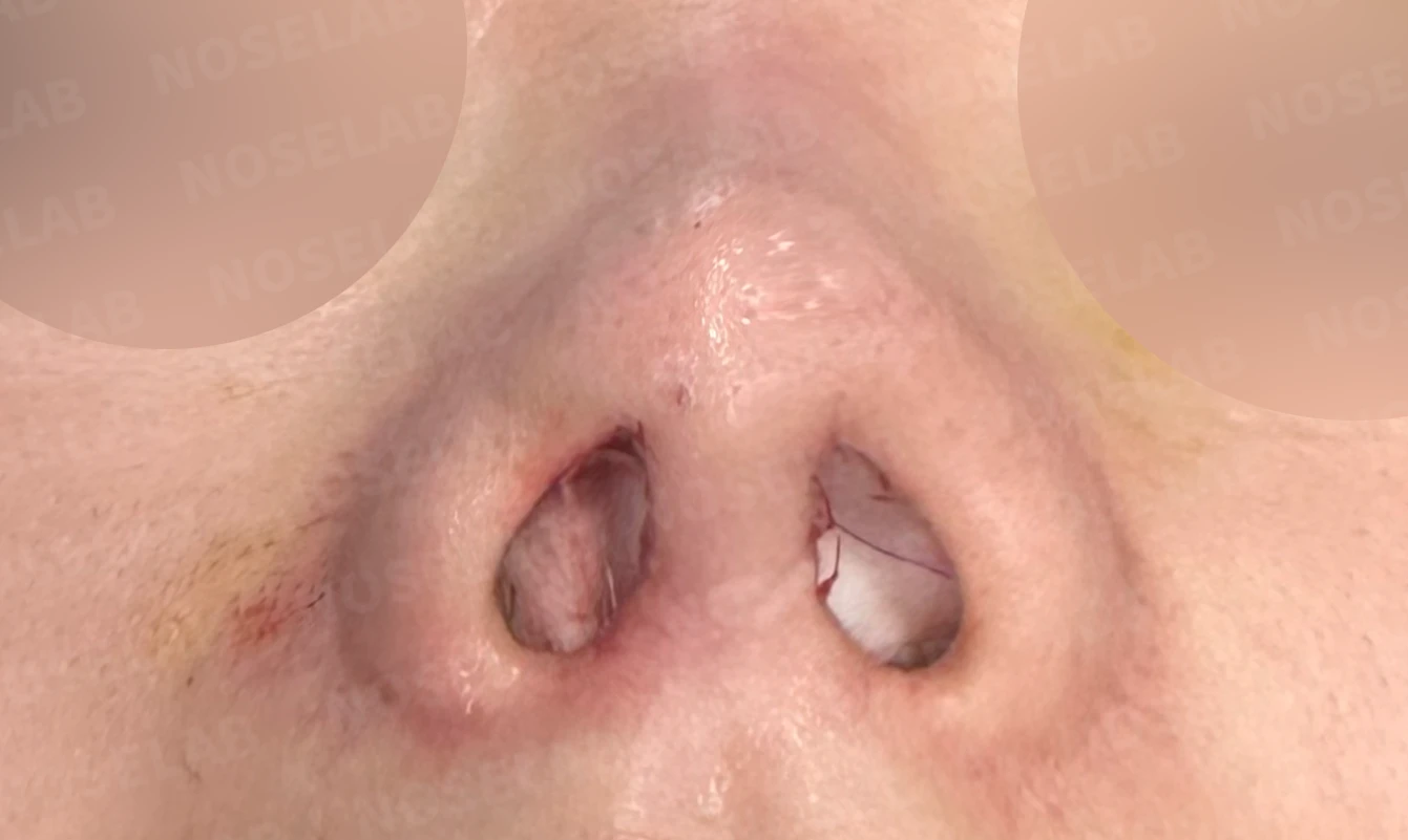 이식한 진피가 반복해서 흡수되는 이유, 재건은 어떻게 하나 — 수술 전 / 수술 직후 0일 직후 사진은 부기가 있는 상태로 최종 결과와 다를 수 있습니다.