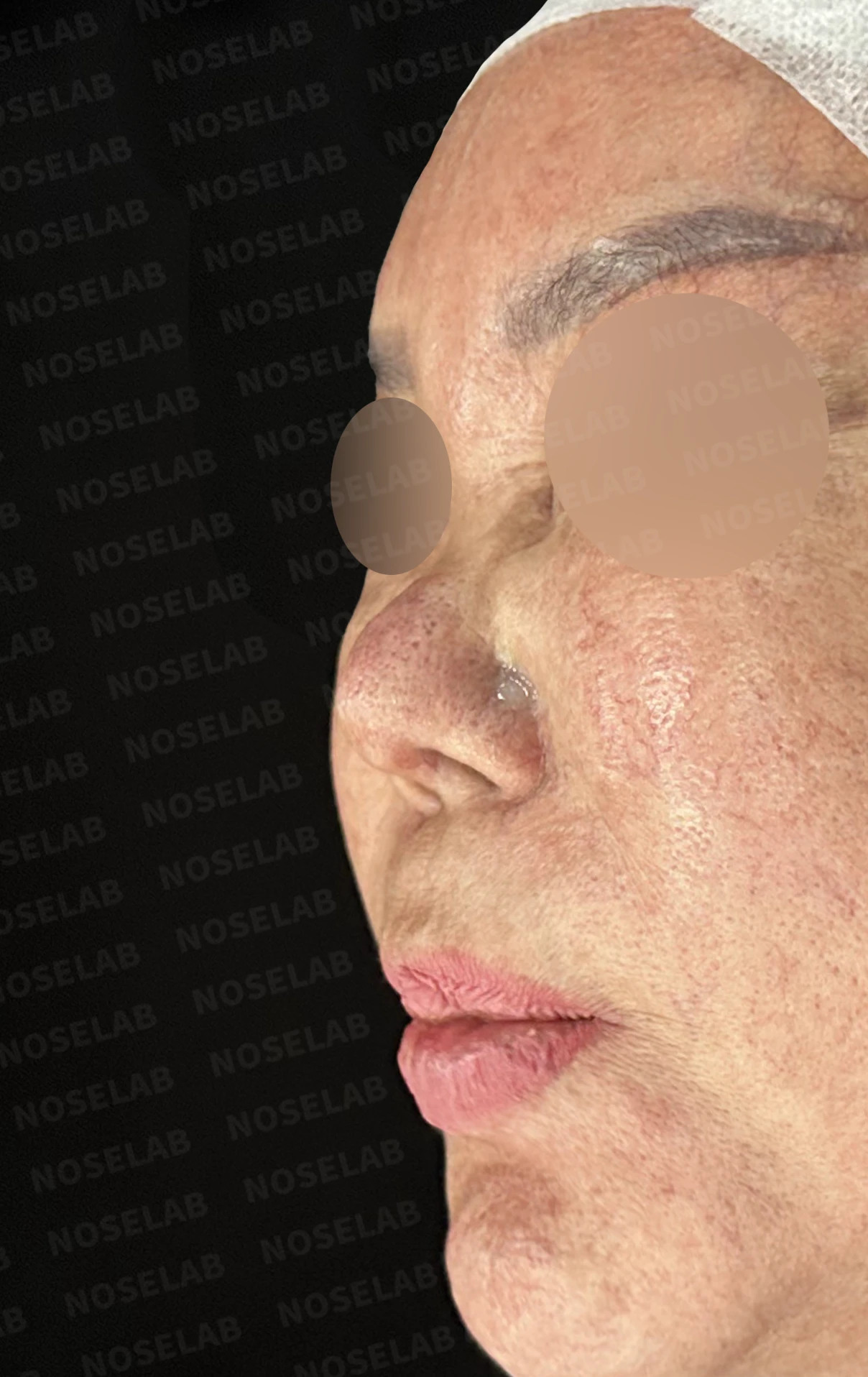 보형물 염증으로 손상된 코, 휴식기 후 기증늑연골로 안전하게 재건한 코재수술 — 전(좌) 직후(후)
