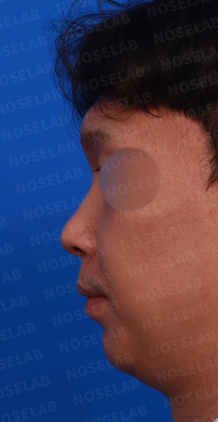 콧대 시작점과 얼굴 비율을 고려한 코성형 방법 — 수술전 정면, 좌측 측면, 비스듬한 측면 사진입니다.