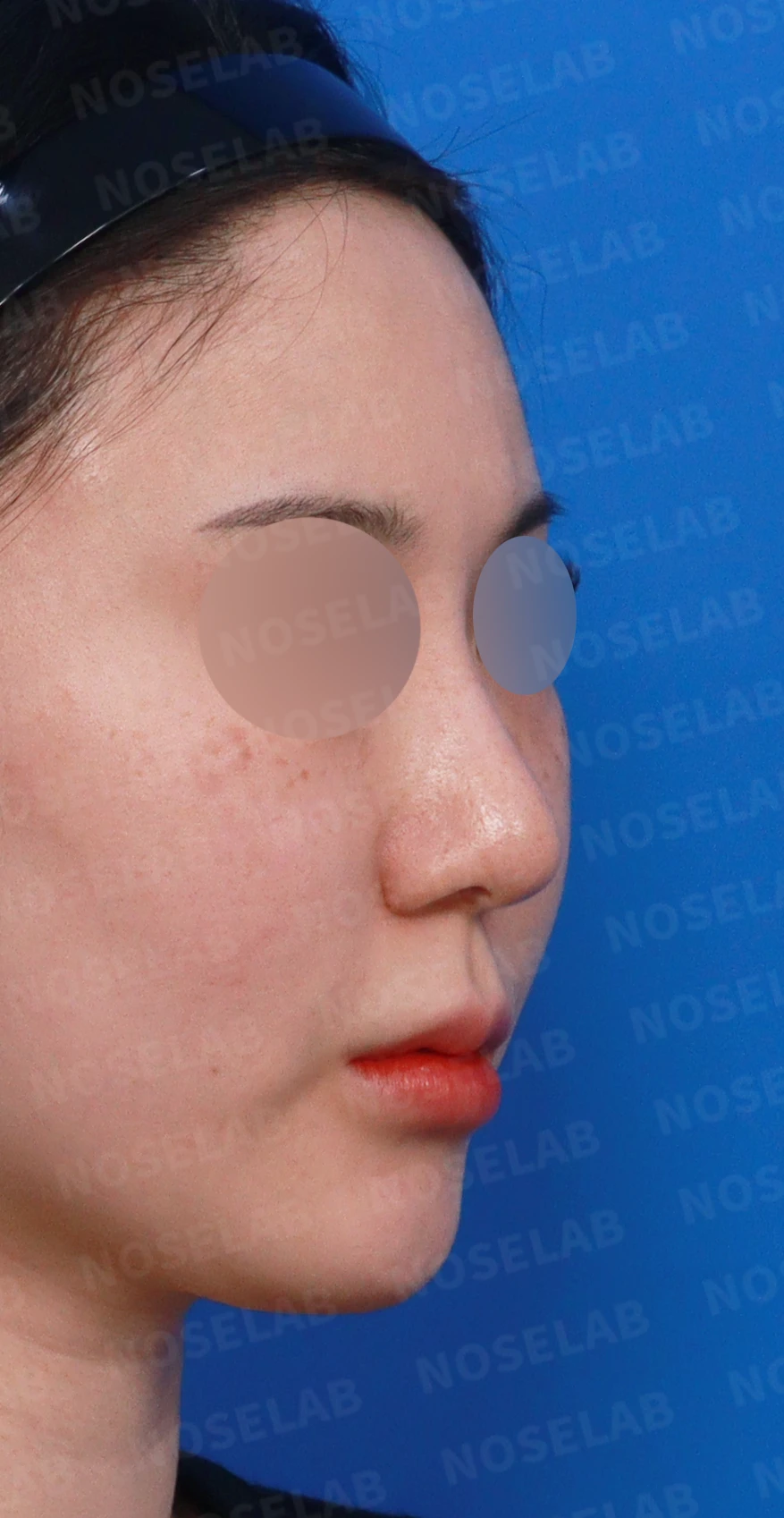 길고 뭉툭한 코, 자가늑연골로 화려하면서 자연스럽게 — 디자인 상담 우측 측면, 비스듬한 측면, 비공 사진입니다.