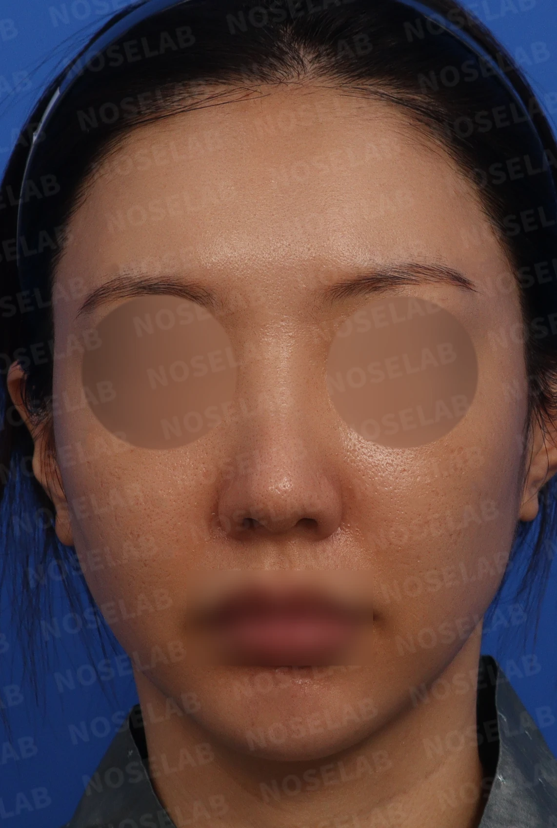 반복 수술 후 긴 코와 높은 시작점의 재수술 방법 — 본문 사진 1