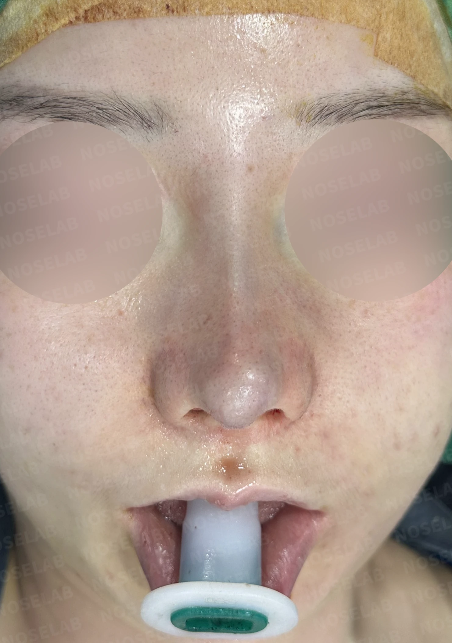휘어진 코와 비공 비대칭, 자가늑연골 비중격 재건으로 완성한 코재수술 — 전(좌) 직후(후)