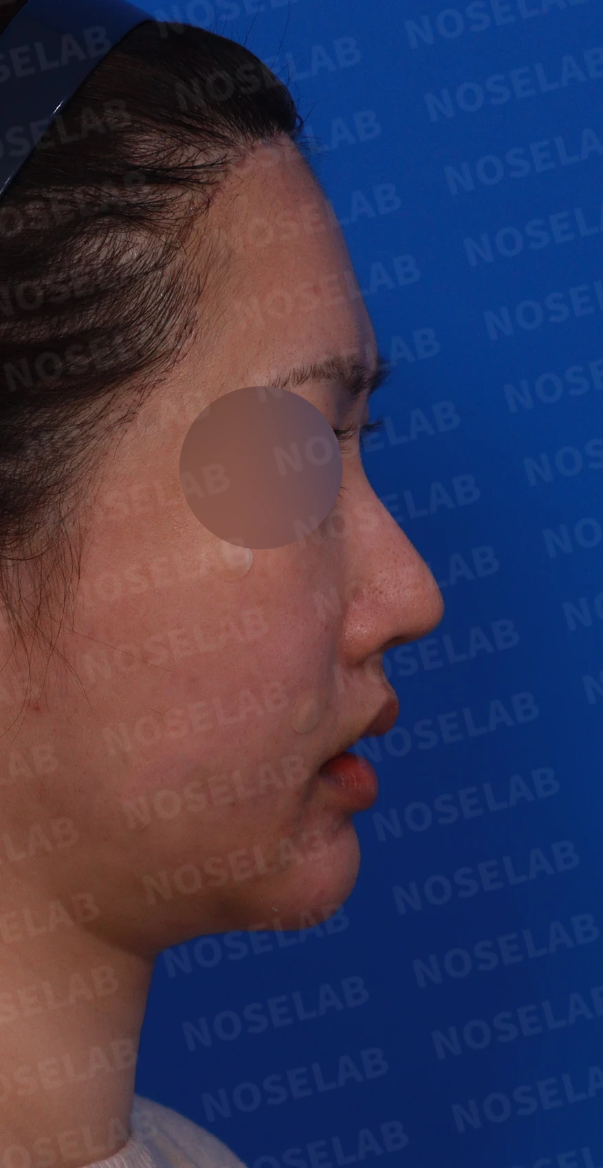 재수술한 코가 휘어 보이고 코끝이 처지는 이유 — 디자인 상담 우측 비스듬한 측면, 측면, 비공 사진