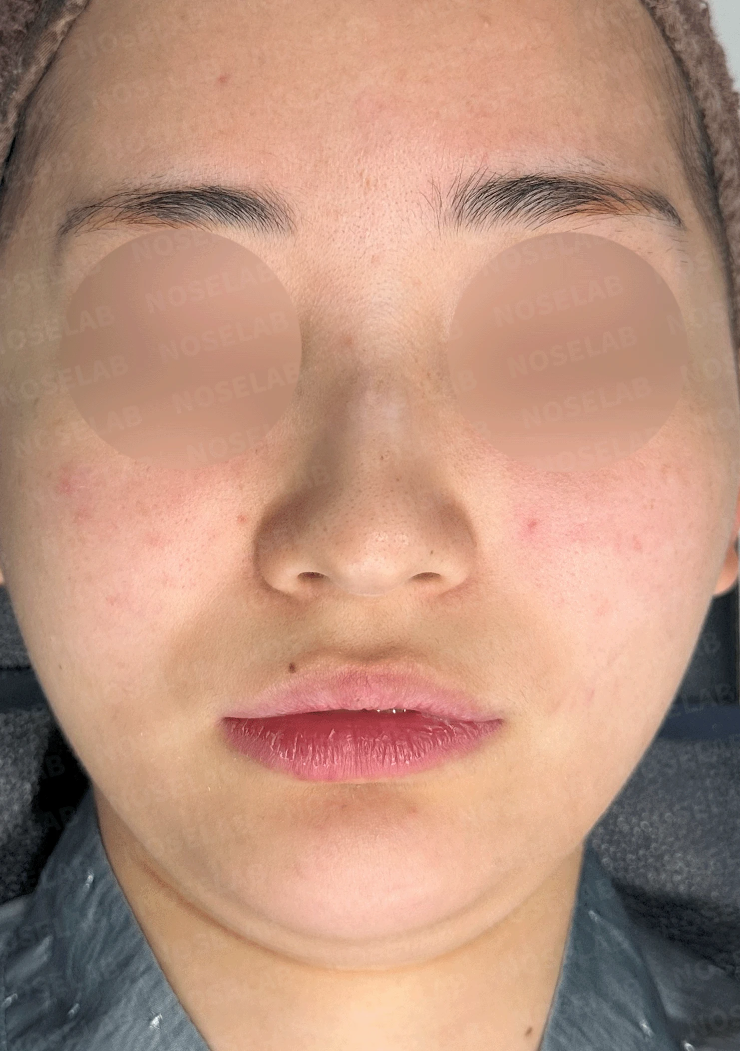 웃을 때만 화살코가 되는 이유와 코끝 연골 교정 방법 — 본문 사진 9