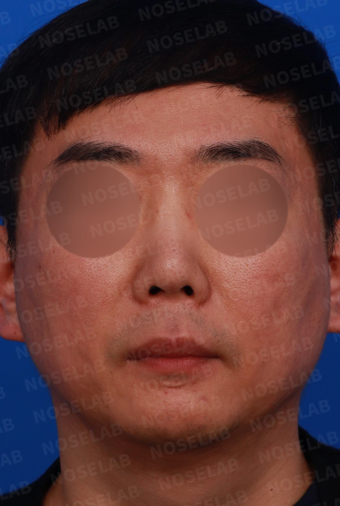 매부리코 수술 후 비대칭의 재수술 방법 — 디자인 상담 정면, 좌측 측면, 비스듬한 측면 사진