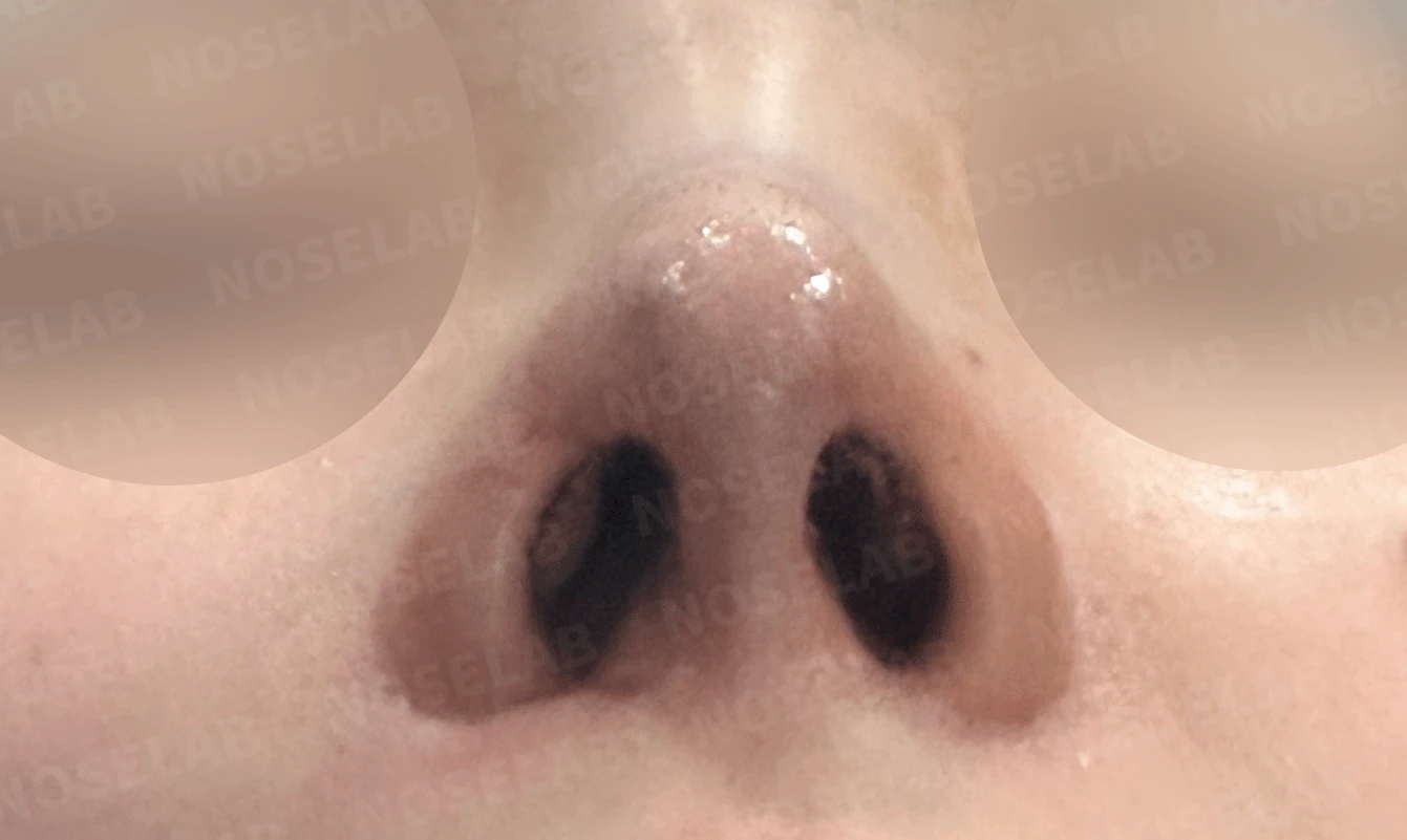 여러 번 수술해도 콧대가 낮고 복코가 남는 이유, 늑연골 재건과 얼굴 균형 — 본문 사진 14