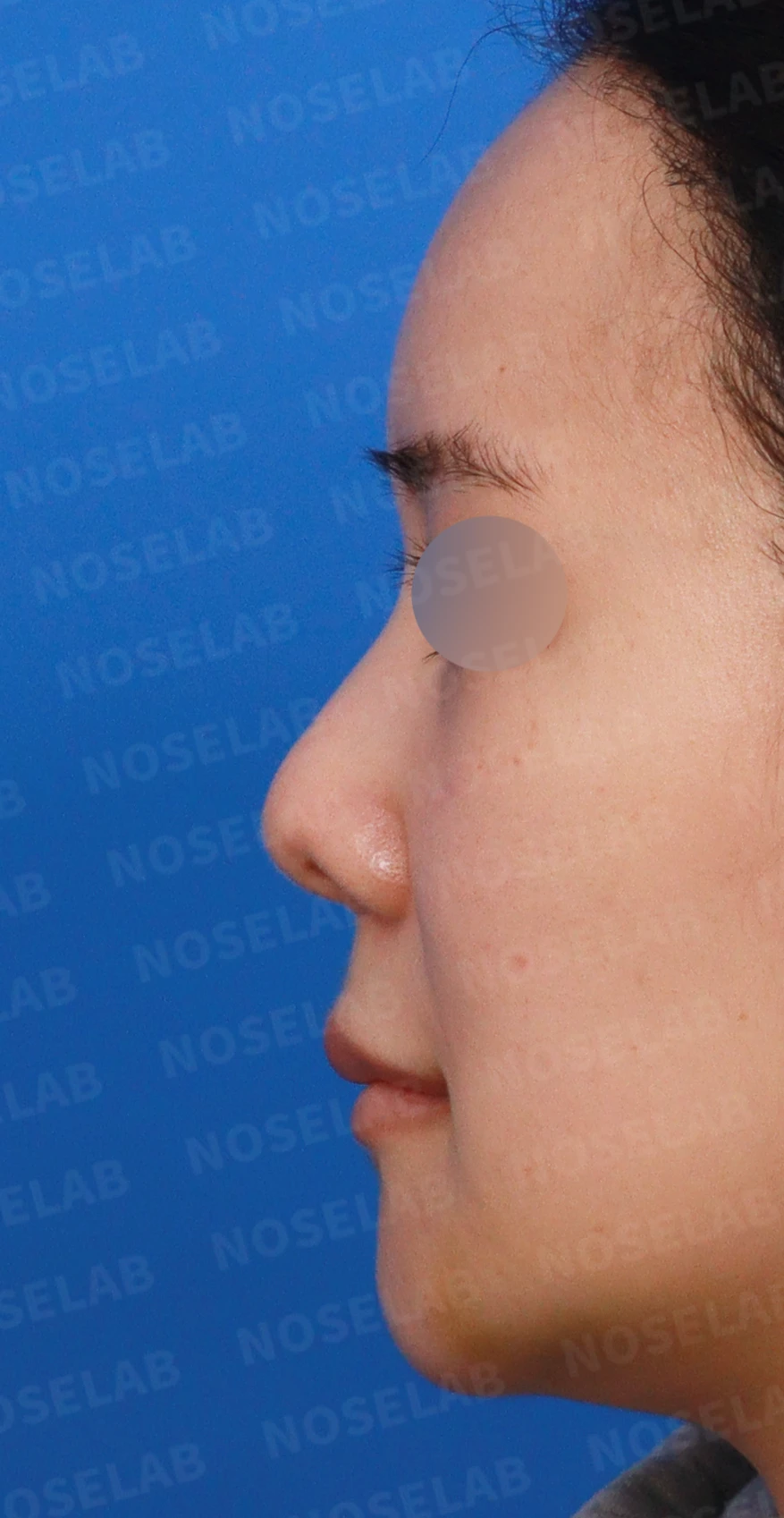 들린 코와 한쪽만 찝힌 콧구멍이 생기는 이유, 무보형물 재건은 어떻게 하나 — 디자인 상담 정면, 좌측 측면, 비스듬한 측면 사진입니다.